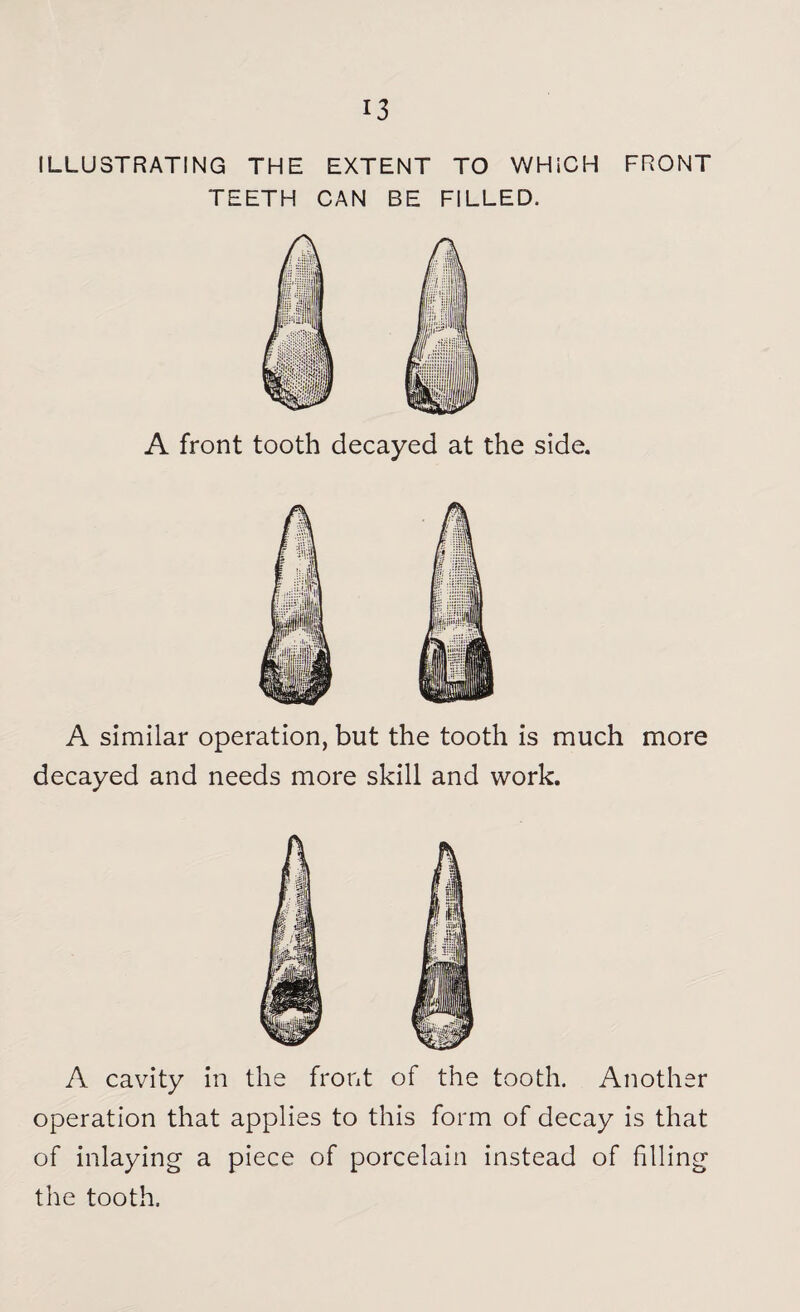 ILLUSTRATING THE EXTENT TO WHICH FRONT TEETH CAN BE FILLED. A front tooth decayed at the side. A similar operation, but the tooth is much more decayed and needs more skill and work. A cavity in the front of the tooth. Another operation that applies to this form of decay is that of inlaying a piece of porcelain instead of filling the tooth.