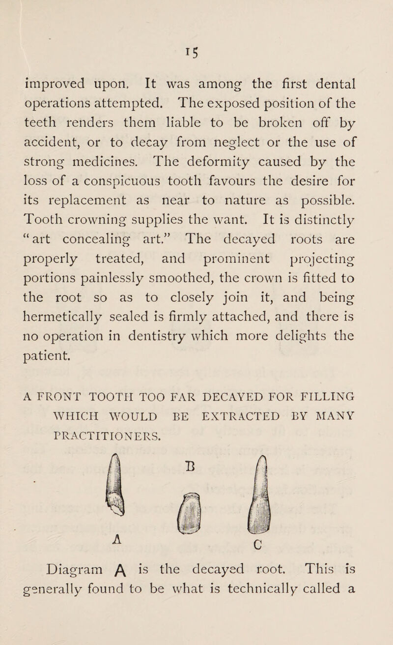 T5 improved upon. It was among the first dental operations attempted. The exposed position of the teeth renders them liable to be broken off by accident, or to decay from neglect or the use of strong medicines. The deformity caused by the loss of a conspicuous tooth favours the desire for its replacement as near to nature as possible. Tooth crowning supplies the want. It is distinctly “ art concealing art.” The decayed roots are properly treated, and prominent projecting portions painlessly smoothed, the crown is fitted to the root so as to closely join it, and being hermetically sealed is firmly attached, and there is no operation in dentistry which more delights the patient. A FRONT TOOTH TOO FAR DECAYED FOR FILLING WHICH WOULD BE EXTRACTED BY MANY PRACTITIONERS. Diagram /\ is the decayed root. This is generally found to be what is technically called a