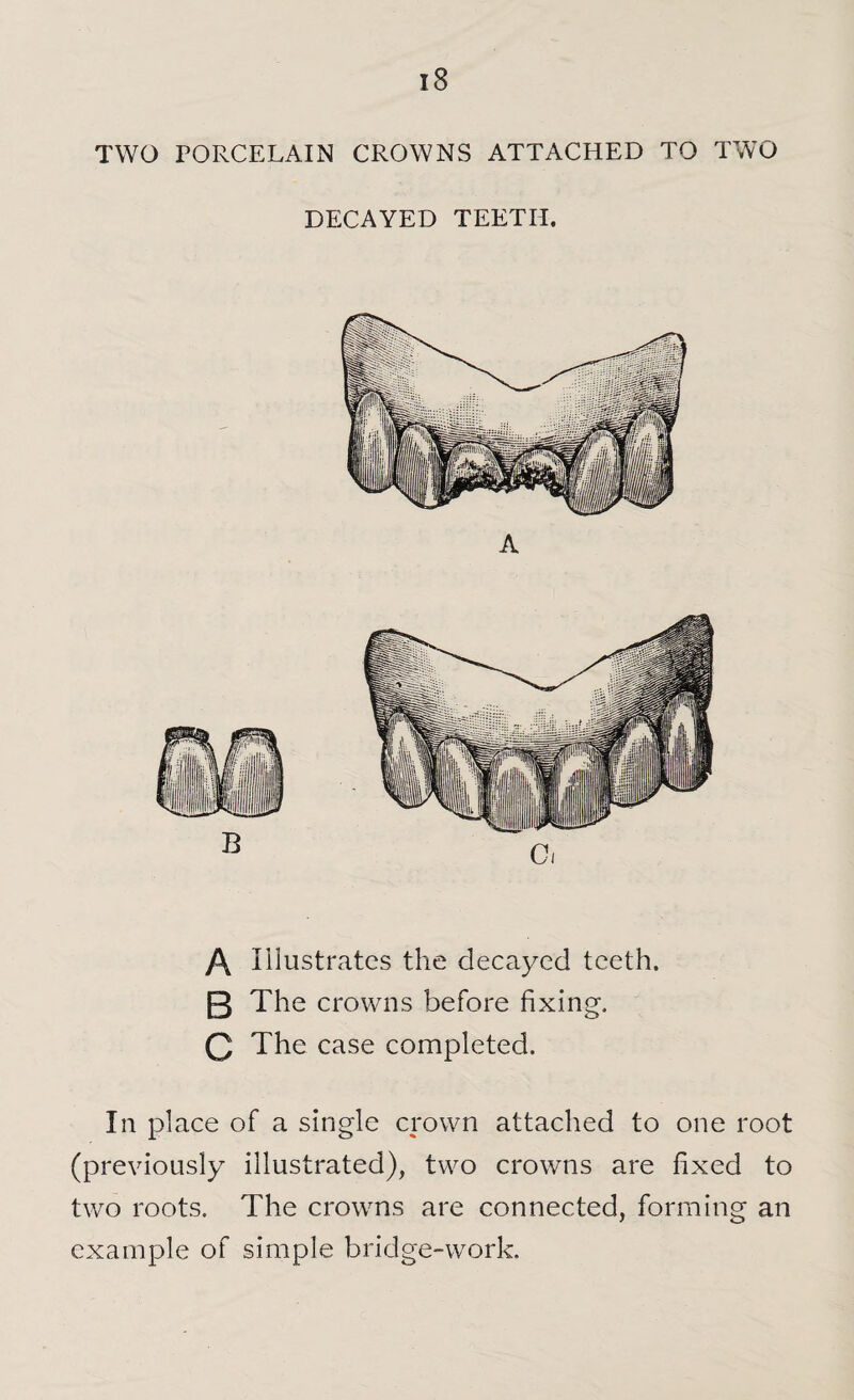 TWO PORCELAIN CROWNS ATTACHED TO TWO DECAYED TEETH. A Illustrates the decayed teeth. B The crowns before fixing. Q The case completed. In place of a single crown attached to one root (previously illustrated), two crowns are fixed to two roots. The crowns are connected, forming an example of simple bridge-work.