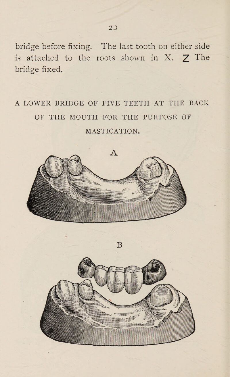2 J bridge before fixing;. The last tooth on either side o o is attached to the roots shown in X. 2 The bridge fixed. A LOWER BRIDGE OF FIVE TEETH AT THE BACK OF THE MOUTH FOR THE PURPOSE OF MASTICATION. B