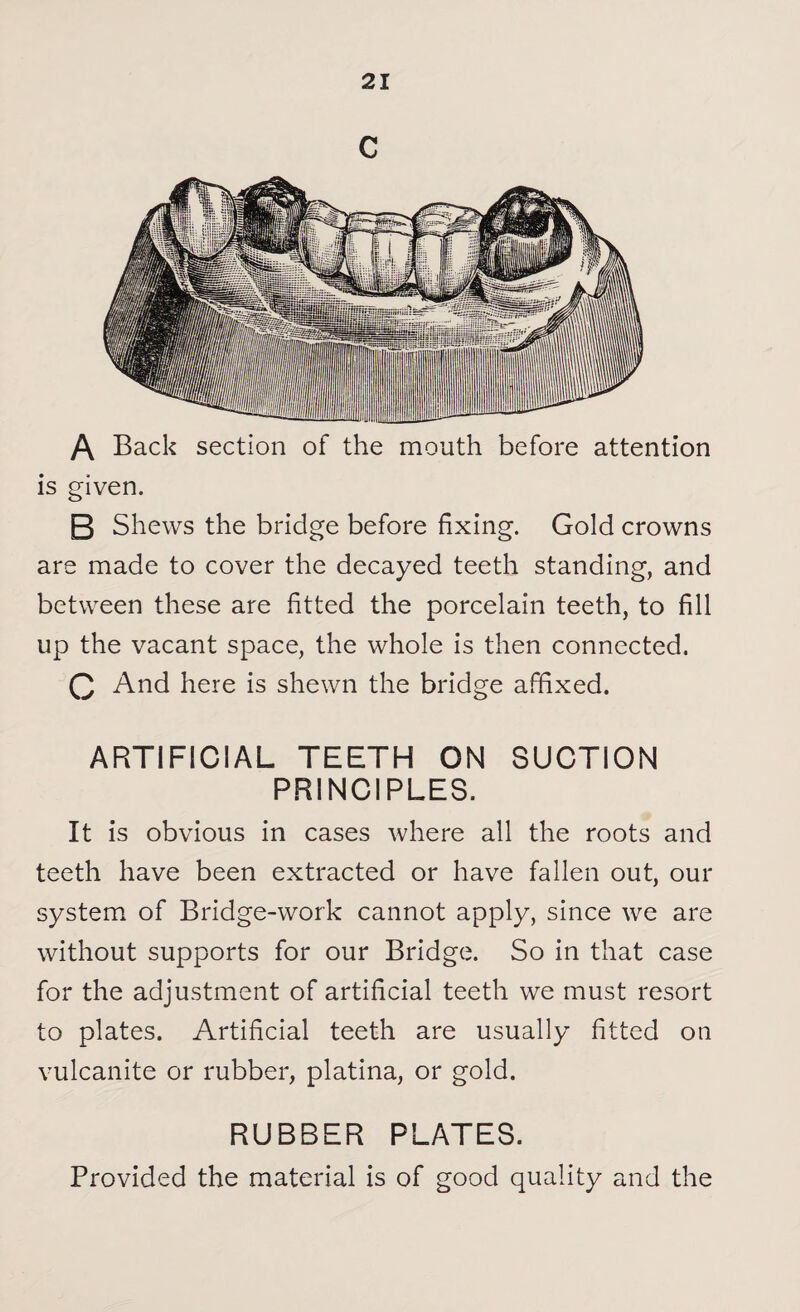c A Back section of the mouth before attention is given. B Shews the bridge before fixing. Gold crowns are made to cover the decayed teeth standing, and between these are fitted the porcelain teeth, to fill up the vacant space, the whole is then connected. Q And here is shewn the bridge affixed. ARTIFICIAL TEETH ON SUCTION PRINCIPLES. It is obvious in cases where all the roots and teeth have been extracted or have fallen out, our system of Bridge-work cannot apply, since we are without supports for our Bridge. So in that case for the adjustment of artificial teeth we must resort to plates. Artificial teeth are usually fitted on vulcanite or rubber, platina, or gold. RUBBER PLATES. Provided the material is of good quality and the