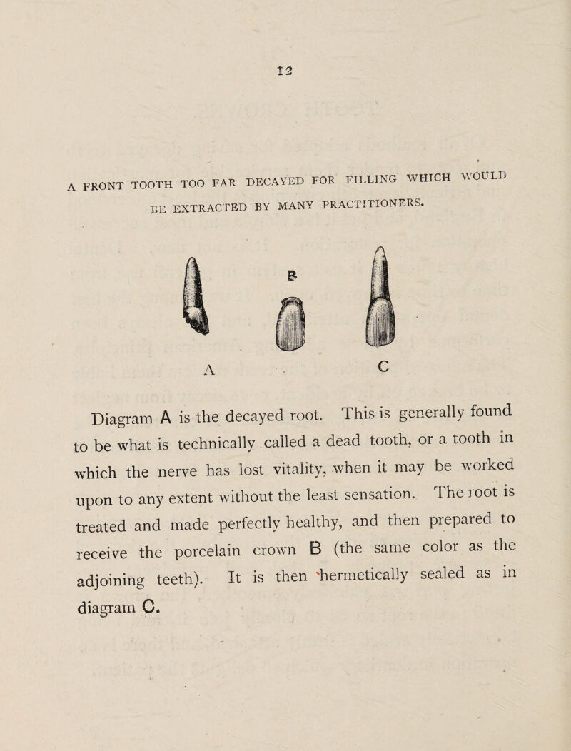 A FRONT TOOTH TOO FAR DECAYED FOR FILLING WHICH WOULD LE EXTRACTED BY MANY PRACTITIONERS. B A C Diagram A is the decayed root. This is generally found to be what is technically called a dead tooth, or a tooth in which the nerve has lost vitality, when it may be worked upon to any extent without the least sensation. The root is treated and made perfectly healthy, and then prepared to receive the porcelain crown B (the same color as the adjoining teeth). It is then 'hermetically sealed as in diagram C.