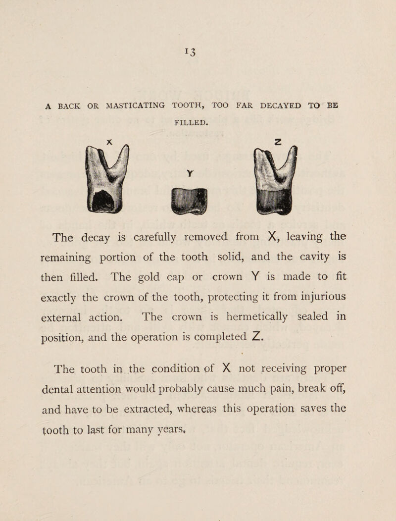 A BACK OR MASTICATING TOOTH, TOO FAR DECAYED TO BE FILLED. The decay is carefully removed from X, leaving the remaining portion of the tooth solid, and the cavity is then filled. The gold cap or crown Y is made to fit exactly the crown of the tooth, protecting it from injurious external action. The crown is hermetically sealed in position, and the operation is completed Z. The tooth in the condition of X not receiving proper dental attention would probably cause much pain, break off, and have to be extracted, whereas this operation saves the tooth to last for many years.