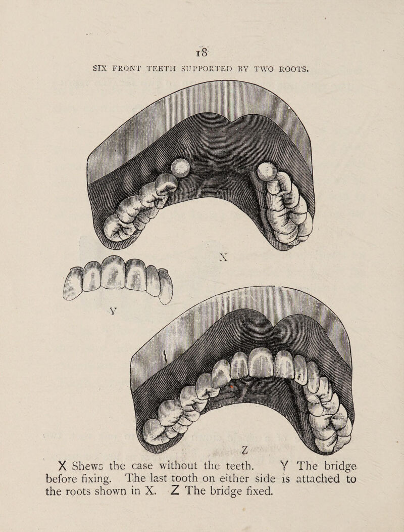 SIX FRONT TEETH SUPPORTED BY TWO ROOTS. X Shews the case without the teeth. Y The bridge before fixing. The last tooth on either side is attached to the roots shown in X. Z The bridge fixed.
