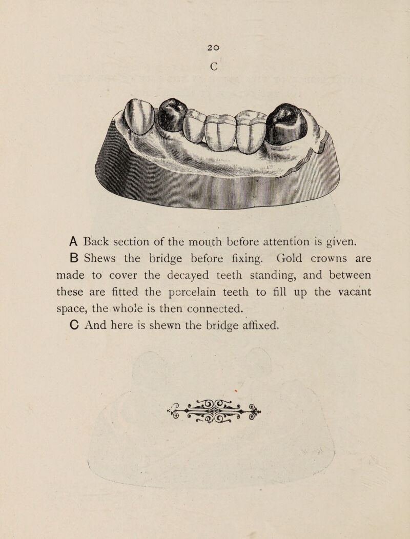 c A Back section of the mouth before attention is given. B Shews the bridge before fixing. Gold crowns are made to cover the decayed teeth standing, and between these are fitted the porcelain teeth to fill up the vacant space, the whole is then connected. C And here is shewn the bridge affixed.