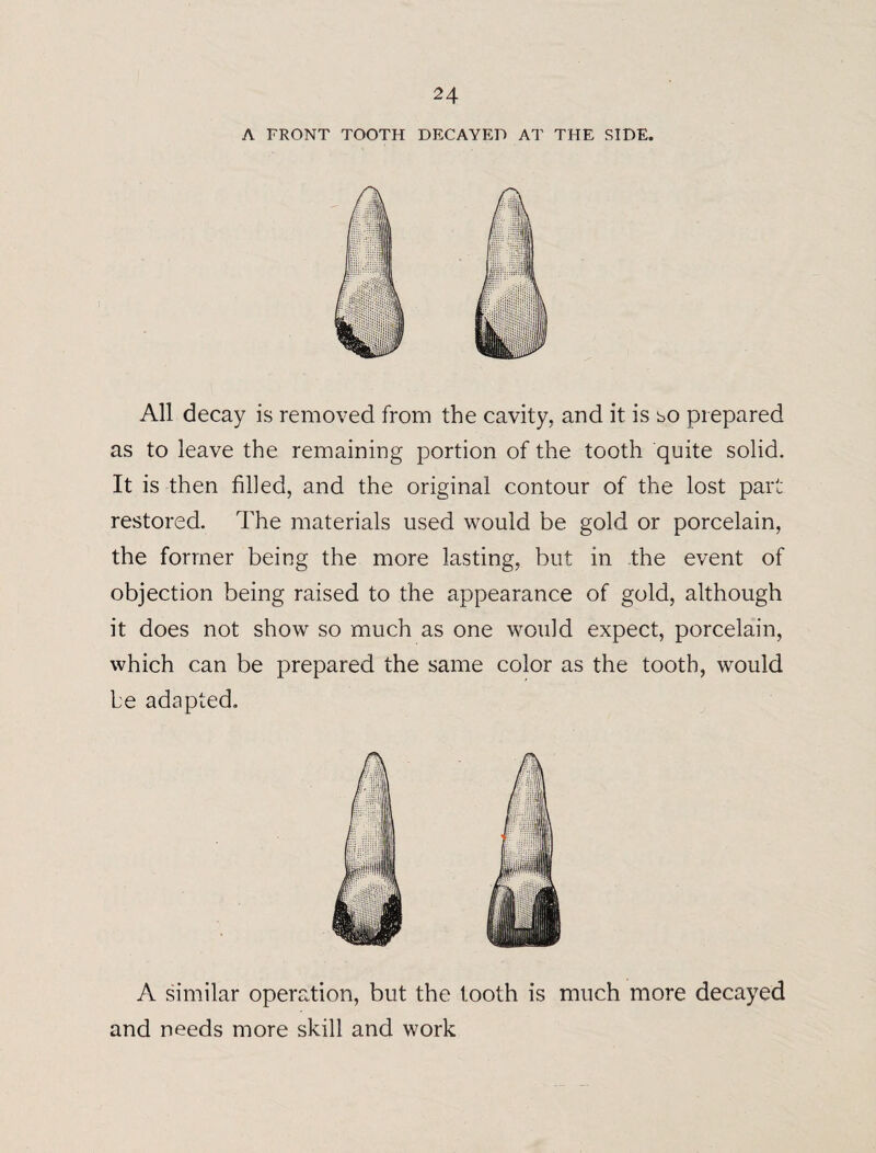 A FRONT TOOTH DECAYED AT THE SIDE. All decay is removed from the cavity, and it is so prepared as to leave the remaining portion of the tooth quite solid. It is then filled, and the original contour of the lost part restored. The materials used would be gold or porcelain, the former being the more lasting, but in the event of objection being raised to the appearance of gold, although it does not show so much as one would expect, porcelain, which can be prepared the same color as the tooth, would be adapted. A similar operation, but the tooth is much more decayed and needs more skill and work