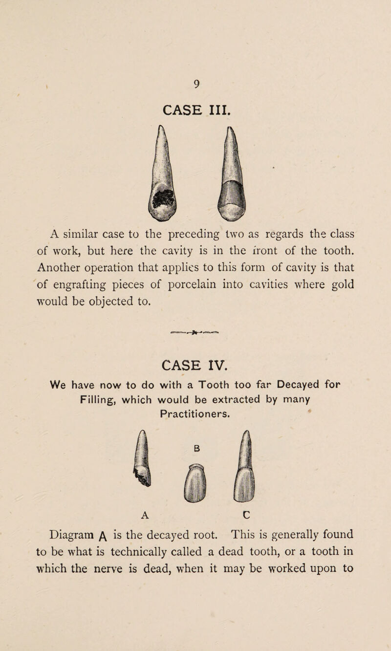 A similar case to the preceding two as regards the class of work, but here the cavity is in the front of the tooth. Another operation that applies to this form of cavity is that of engrafting pieces of porcelain into cavities where gold would be objected to. CASE IV. We have now to do with a Tooth too far Decayed for Filling, which would be extracted by many Practitioners. A C Diagram A is the decayed root. This is generally found to be what is technically called a dead tooth, or a tooth in which the nerve is dead, when it may be worked upon to