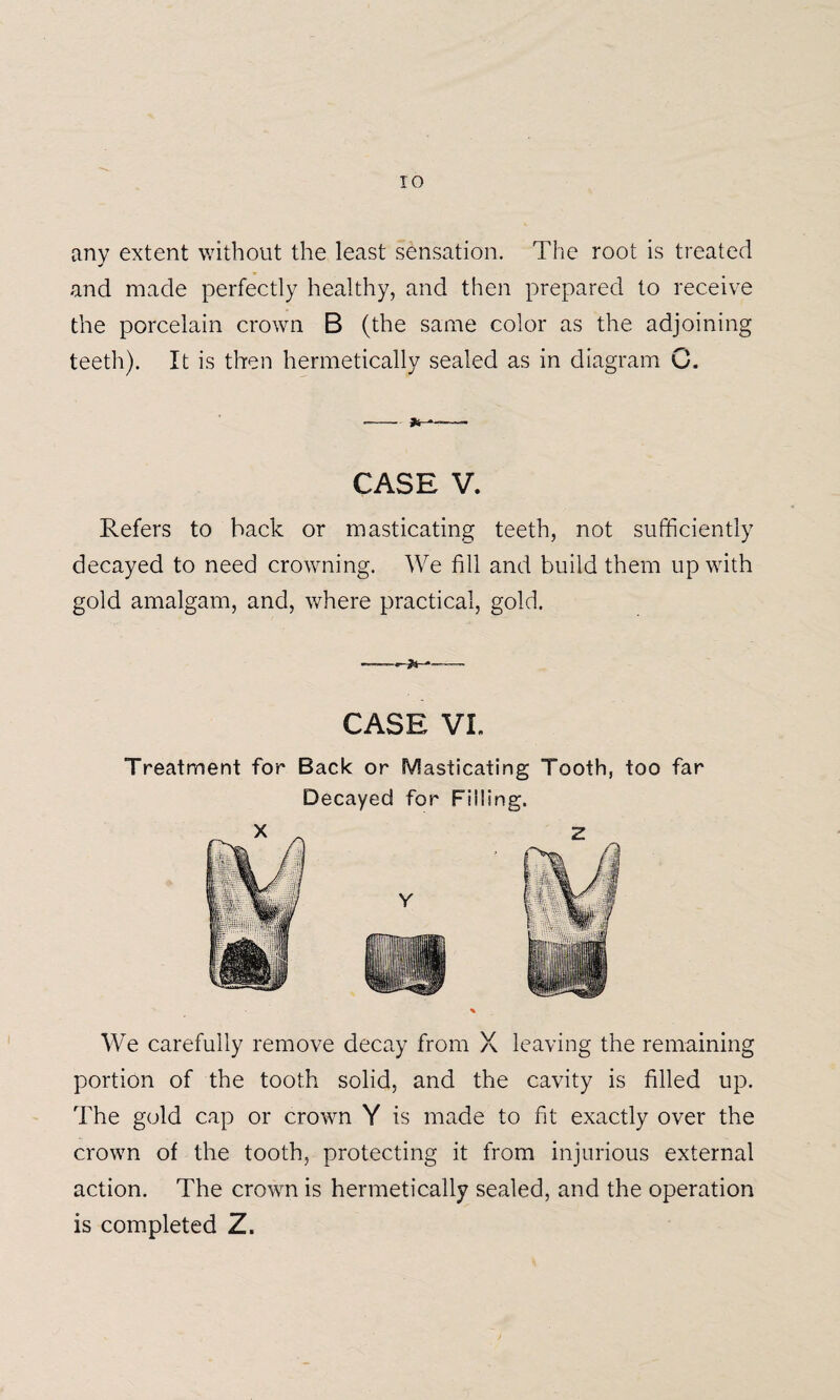 any extent without the least sensation. The root is treated * and made perfectly healthy, and then prepared to receive the porcelain crown B (the same color as the adjoining teeth). It is then hermetically sealed as in diagram C. CASE V. Refers to back or masticating teeth, not sufficiently decayed to need crowning. We fill and build them up with gold amalgam, and, where practical, gold. -»• CASE VI. Treatment for Back or Masticating Tooth, too far Decayed for Filling. We carefully remove decay from X leaving the remaining portion of the tooth solid, and the cavity is filled up. The gold cap or crown Y is made to fit exactly over the crown of the tooth, protecting it from injurious external action. The crown is hermetically sealed, and the operation is completed Z.