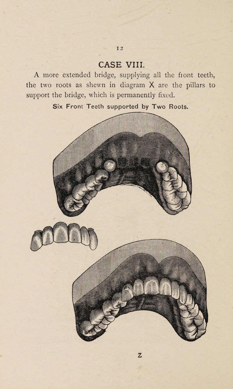CASE VIII. A more extended bridge, supplying all the front teeth, the two roots as shewn in diagram X are the pillars to support the bridge, which is permanently fixed. Six Front Teeth supported by Two Roots. Z
