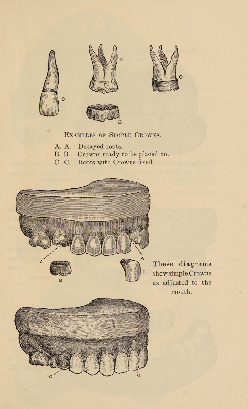 Examples of Simple Crowns. A. A. Decayed roots. B. B. Crowns ready to be placed on. C. C. Roots with Crowns fixed. These diagrams show simple Crowns as adjusted to the mouth. c c