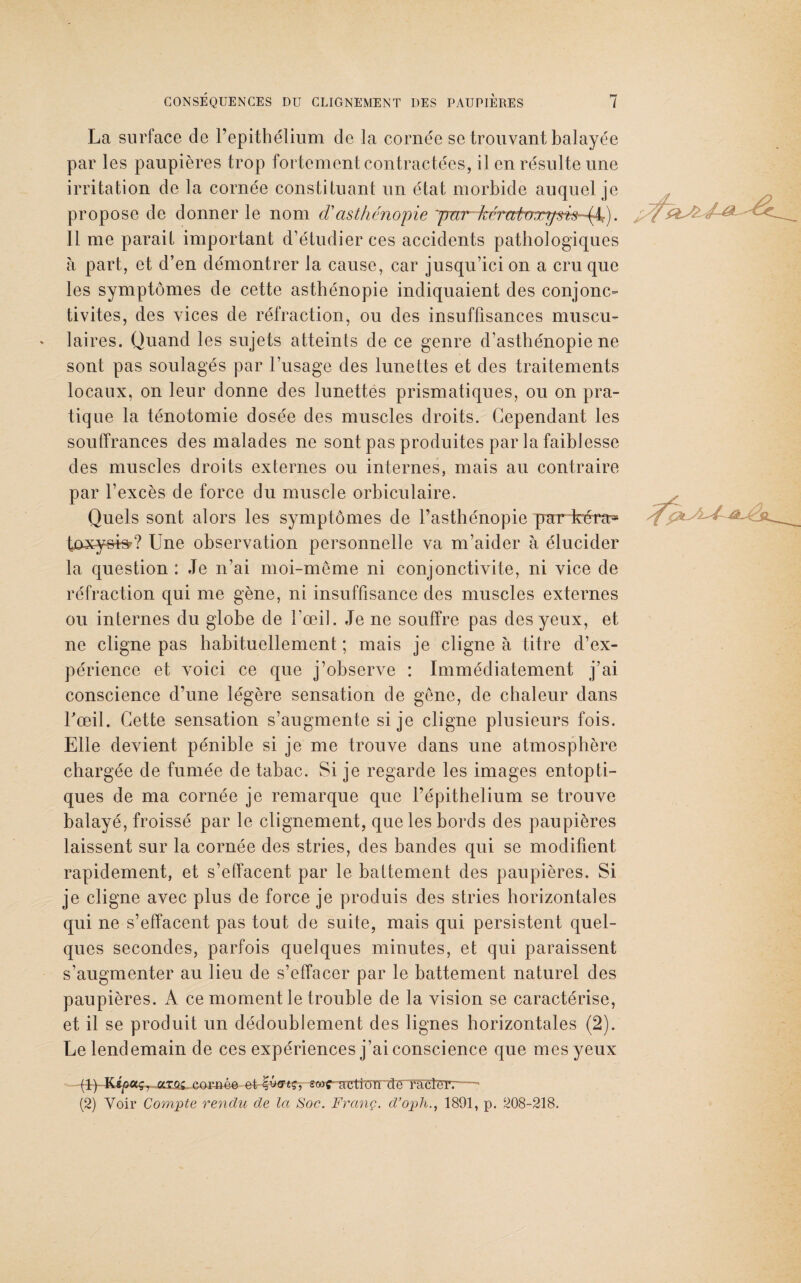 La surface de l’epithélium de la cornée se trouvant balayée par les paupières trop fortement contractées, il en résulte une irritation de la cornée constituant un état morbide auquel je propose de donner le nom d'asthénopie ynr k(Tœt(7T7p?^k~4^;). Il me parait important d’étudier ces accidents pathologiques à part, et d’en démontrer la cause, car jusqu’ici on a cru que les symptômes de cette asthénopie indiquaient des conjonc¬ tivites, des vices de réfraction, ou des insuffisances muscu¬ laires. Quand les sujets atteints de ce genre d’asthénopie ne sont pas soulagés par l’usage des lunettes et des traitements locaux, on leur donne des lunettes prismatiques, ou on pra¬ tique la ténotomie dosée des muscles droits. Cependant les souffrances des malades ne sont pas produites par la faiblesse des muscles droits externes ou internes, mais au contraire par l’excès de force du muscle orbiculaire. Quels sont alors les symptômes de l’asthénopie par kéra* tôxysts?? Une observation personnelle va m’aider à élucider la question : Je n’ai moi-meme ni conjonctivite, ni vice de réfraction qui me gène, ni insuffisance des muscles externes ou internes du globe de l’œil. Je ne souffre pas des yeux, et ne cligne pas habituellement ; mais je cligne à titre d’ex¬ périence et voici ce que j’observe : Immédiatement j’ai conscience d’une légère sensation de gêne, de chaleur dans l'œil. Cette sensation s’augmente si je cligne plusieurs fois. Elle devient pénible si je me trouve dans une atmosphère chargée de fumée de tabac. Si je regarde les images entopti¬ ques de ma cornée je remarque que l’épithelium se trouve balayé, froissé par le clignement, que les bords des paupières laissent sur la cornée des stries, des bandes qui se modifient rapidement, et s’effacent par le battement des paupières. Si je cligne avec plus de force je produis des stries horizontales qui ne s’effacent pas tout de suite, mais qui persistent quel¬ ques secondes, parfois quelques minutes, et qui paraissent s’augmenter au lieu de s’effacer par le battement naturel des paupières. A ce moment le trouble de la vision se caractérise, et il se produit un dédoublement des lignes horizontales (2). Le lendemain de ces expériences j’ai conscience que mes yeux (ly-Kij&aç, .a.xQi cowioe et f*»ï-acttüir de faëTïïr.— (2) Voir Compte rendu de la Soc. Franç. d’oph., 1891, p. 208-218.