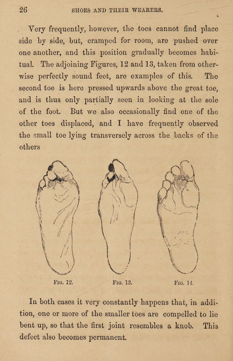 Very frequently, however, the toes cannot find place side by side, but, cramped for room, are pushed over one another, and this position gradually becomes habi¬ tual. The adjoining Figures, 12 and 13, taken from other¬ wise perfectly sound feet, are examples of this. The second toe is here pressed upwards above the great toe, and is thus only partially seen in looking at the sole of the foot. But we also occasionally find one of the other toes displaced, and I have frequently observed the small toe lying transversely across the backs of the others In both cases it very constantly happens that, in addi¬ tion, one or more of the smaller toes are compelled to lie bent up, so that the first joint resembles a knob. This defect also becomes permanent.