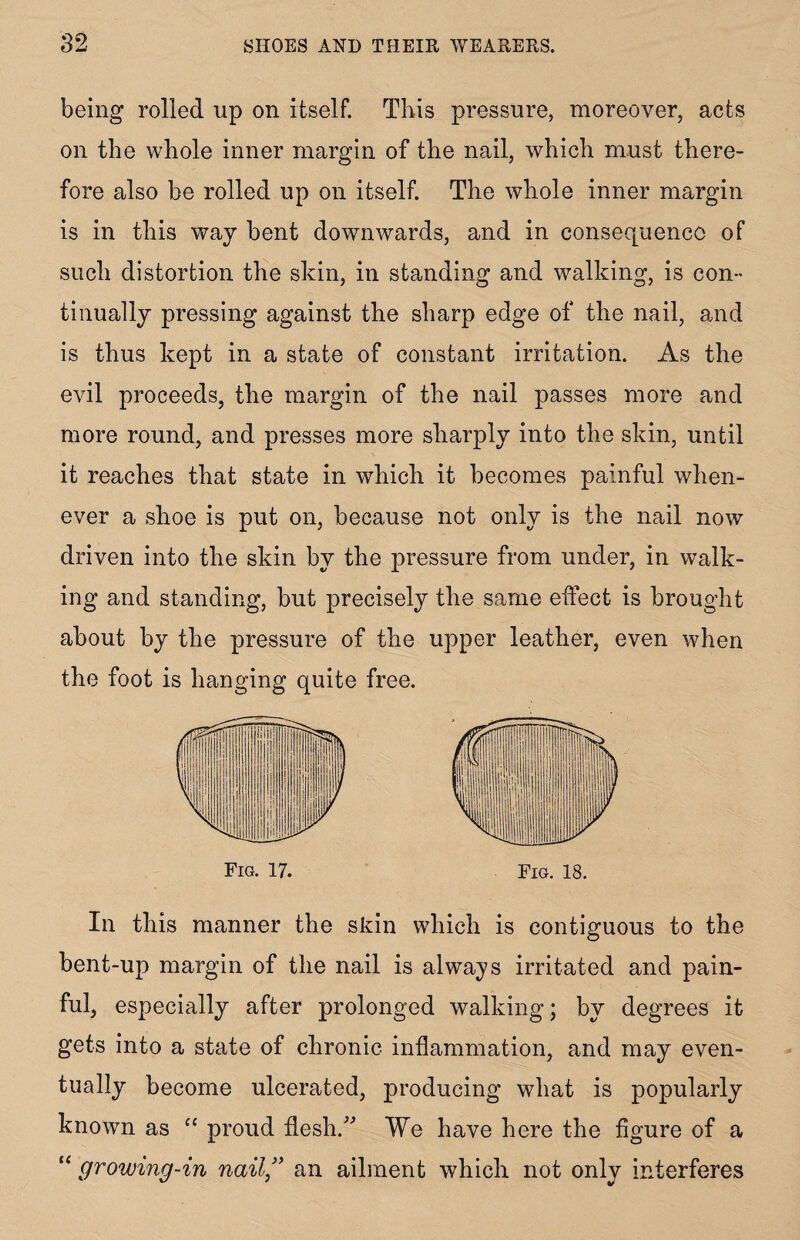 being rolled up on itself. This pressure, moreover, acts on the whole inner margin of the nail, which must there¬ fore also be rolled up on itself. The whole inner margin is in this way bent downwards, and in consequence of such distortion the skin, in standing and walking, is con¬ tinually pressing against the sharp edge of the nail, and is thus kept in a state of constant irritation. As the evil proceeds, the margin of the nail passes more and more round, and presses more sharply into the skin, until it reaches that state in which it becomes painful when¬ ever a shoe is put on, because not only is the nail now driven into the skin by the pressure from under, in walk¬ ing and standing, but precisely the same effect is brought about by the pressure of the upper leather, even when the foot is hanging quite free. In this mariner the skin which is contiguous to the bent-up margin of the nail is always irritated and pain¬ ful, especially after prolonged walking; by degrees it gets into a state of chronic inflammation, and may even¬ tually become ulcerated, producing what is popularly known as c£ proud flesh.” We have here the figure of a “ growing-in nail ” an ailment which not only interferes
