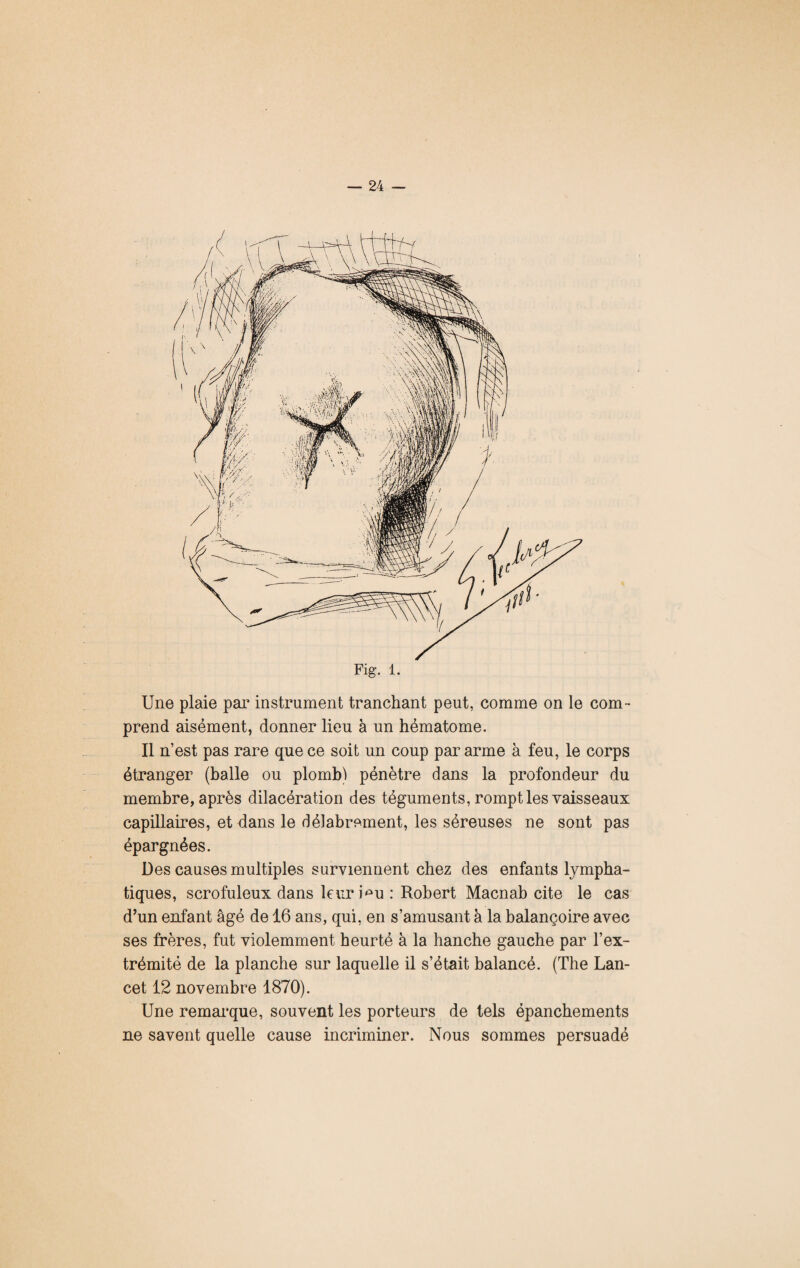 Une plaie par instrument tranchant peut, comme on le com¬ prend aisément, donner lieu à un hématome. Il n’est pas rare que ce soit un coup par arme à feu, le corps étranger (balle ou plombl pénètre dans la profondeur du membre, après dilacération des téguments, rompt les vaisseaux capillaires, et dans le délabrement, les séreuses ne sont pas épargnées. Des causes multiples surviennent chez des enfants lympha¬ tiques, scrofuleux dans leur mu : Robert Macnab cite le cas d’un enfant âgé de 16 ans, qui, en s’amusant à la balançoire avec ses frères, fut violemment heurté à la hanche gauche par l’ex¬ trémité de la planche sur laquelle il s’était balancé. (The Lan¬ cet 12 novembre 1870). Une remarque, souvent les porteurs de tels épanchements ne savent quelle cause incriminer. Nous sommes persuadé