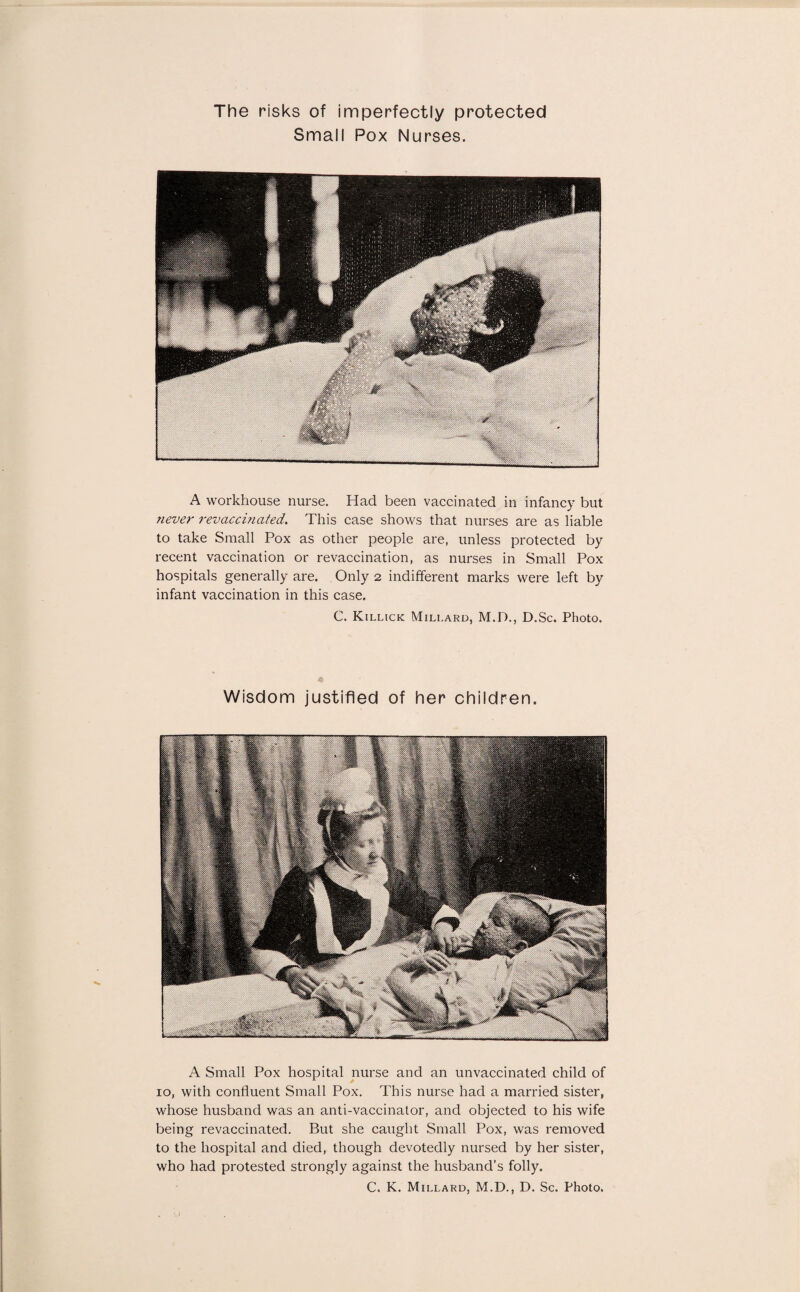 The risks of imperfectly protected Small Pox Nurses. A workhouse nurse. Had been vaccinated in infancy but never revciccinated,. This case shows that nurses are as liable to take Small Pox as other people are, unless protected by recent vaccination or revaccination, as nurses in Small Pox hospitals generally are. Only 2 indifferent marks were left by infant vaccination in this case. C. Killick Millard, M.D., D.Sc. Photo. Wisdom justified of her children. A Small Pox hospital nurse and an unvaccinated child of 10, with confluent Small Pox. This nurse had a married sister, whose husband was an anti-vaccinator, and objected to his wife being revaccinated. But she caught Small Pox, was removed to the hospital and died, though devotedly nursed by her sister, who had protested strongly against the husband’s folly.