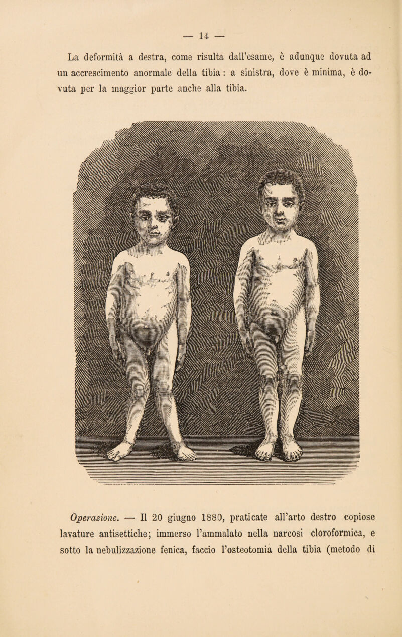 La deformità a destra, come risulta dall’esame, è adunque dovuta ad un accrescimento anormale della tibia : a sinistra, dove è minima, è do¬ vuta per la maggior parte anche alla tibia. Operazione. — Il 20 giugno 1880, praticate all’arto destro copiose lavature antisettiche; immerso l’ammalato nella narcosi cloroformica, e sotto la nebulizzazione fenica, faccio l’osteotomia della tibia (metodo di