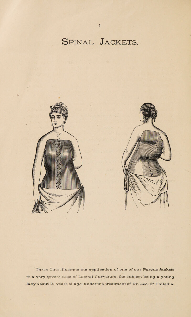 Spinal Jackets. % These Chits Illustrate the application of one of our Porous Jackets to a very severe ease of Lateral Curvature, the subject being a young lady about IS years of age, under the treatment of Dr. Lee, of Philad’a.