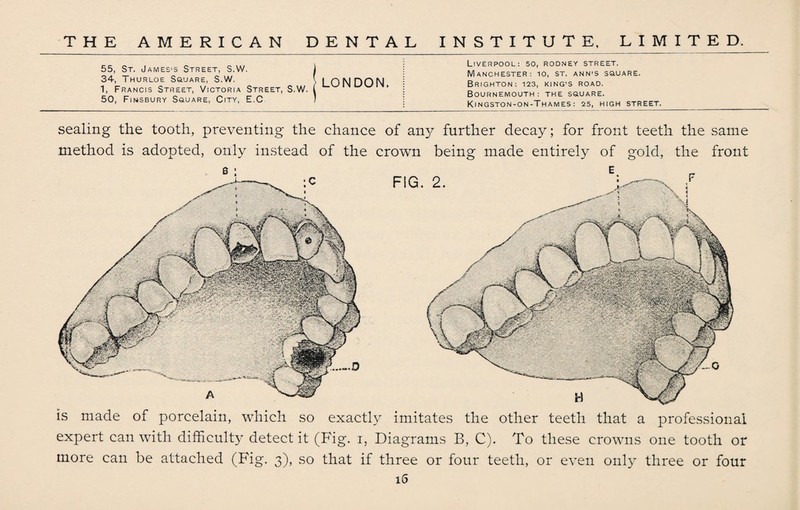 55, St. James's Street, S.W. 34, Thurloe S&'jare, S.W. 1, Francis Street, Victoria Street, S.W. 50, Finsbury Square, City, E.C LONDON. Liverpool: so, rodney street. Manchester: io, st. ann’S ssuare. Brighton: 123, king's road. Bournemouth: the square. KlNGSTON-ON-THAMES: 25, HIGH STREET. sealing the tooth, preventing the chance of any further decay; for front teeth the same method is adopted, only instead of the crown being made entirely of gold, the front FIG. 2. is made of porcelain, which so exactly imitates the other teeth that a professional expert can with difficulty detect it (Fig. i, Diagrams B, C). To these crowns one tooth or more can be attached (Fig. 3), so that if three or four teeth, or even only three or four