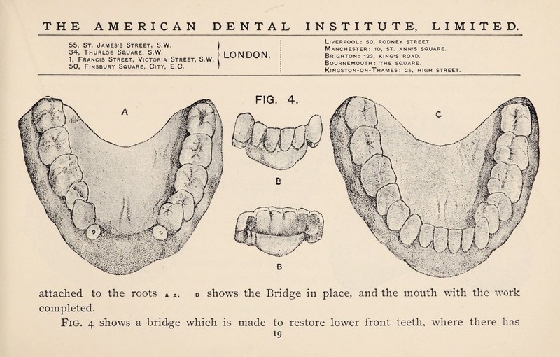 55, St. James’s Street, S.W. 34, Thurloe Square, S.W. 1, Francis Street, Victoria Street, S.W. 50, Finsbury Square, City, E.C. LONDON. Liverpool: so, rodney street. Manchester: io, st. ann’s square. Brighton: 123, king's road. Bournemouth: the square. Kingston-on-Thames: 25, HIGH STREET. attached to the roots A a. d shows the Bridge in place, and the month with the work completed. Fig. 4 shows a bridge which is made to restore lower front teeth, where there has