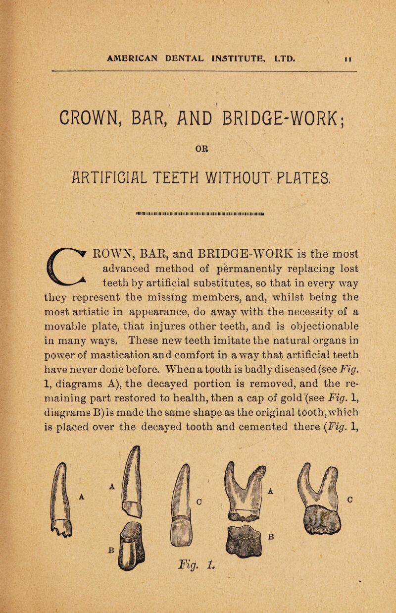 CROWN, BAR, AND BRIDGE-WORK; OR ARTIFICIAL TEETH WITHOUT PLATES. CROWN, BAR, and BRIDGE-WORK is the most advanced method of permanently replacing lost teeth by artificial substitutes, so that in every way they represent the missing members, and, whilst being the most artistic in appearance, do away with the necessity of a movable plate, that injures other teeth, and is objectionable in many ways. These new teeth imitate the natural organs in power of mastication and comfort in away that artificial teeth have never done before. When a tooth is badly diseased (see Fig. 1, diagrams A), the decayed portion is removed, and the re¬ maining part restored to health, then a cap of gold (see Fig. 1, diagrams B)is made the same shape as the original tooth, which is placed over the decayed tooth and cemented there {Fig. 1,