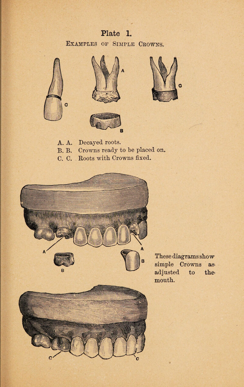 Examples of Simple Crowns, A. A. Decayed roots. B. B. Crowns ready to be placed on. C. C. Roots with Crowns fixed. These diagrams show simple Crowns as- adjusted to the- mouth.