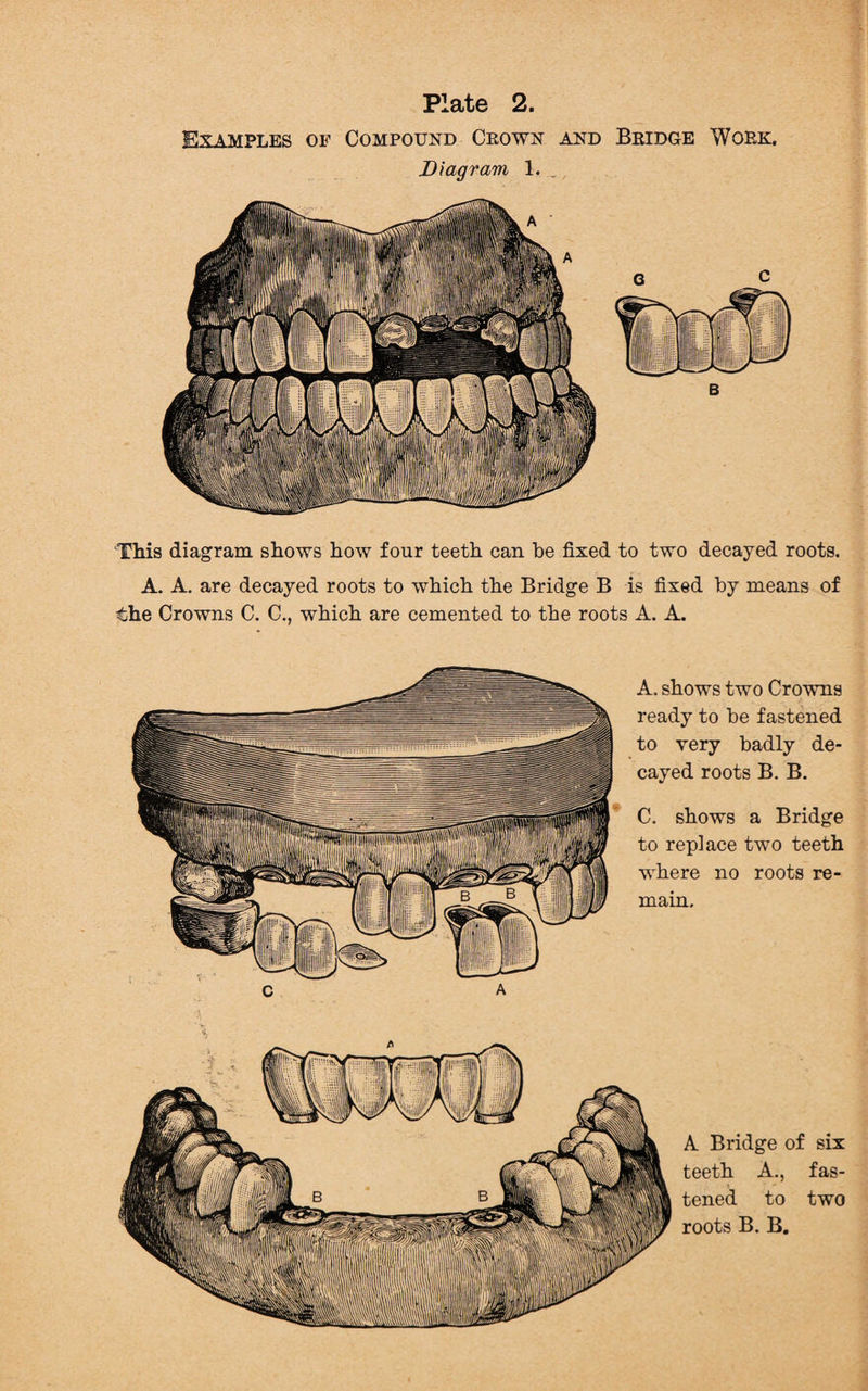 Examples of Compound Crown and Bridge Work. Diagram, 1. This diagram shows how four teeth can be fixed to two decayed roots. A. A. are decayed roots to which the Bridge B is fixed by means of the Crowns C. C., which are cemented to the roots A. A. A. shows two Crowns ready to be fastened to very badly de¬ cayed roots B. B. C. shows a Bridge to replace two teeth where no roots re¬ main. A Bridge of six teeth A., fas¬ tened to two roots B. B.