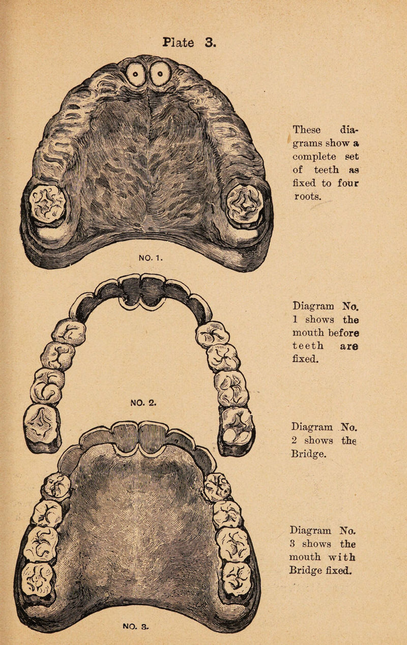 These dia¬ grams show a complete set of teeth as fixed to four roots. Diagram No. 1 shows the mouth before teeth are fixed. Diagram No. 2 shows the Bridge. Diagram No. 3 shows the mouth with Bridge fixed.