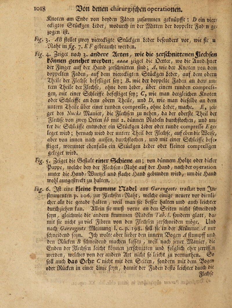 •Änofen am ®nbe Don bereit gäben §ufammen gefnupfft: D etn Dicr; ecftgfcö ©tücfgen iclbcr/ wobureh in her £S?itfcn 5er hoppelte gaben ge; Sogen ifl* Fig. 3, AB pellet jwep Dicrccfigtc ©tücfgen feber befonbers Dor, wie pe « Öla^t in ^ 7>J?F gebraust merhem ■ Fig. 4. 3eiget noh 3. drtbere 2trteit / wie bie $evfibnittenen §lecbfctt tarnten geneset wer&en; aaaa zeiget hie Derter, wo hie 3lus5^ner her ginger auf 5er Jjanb jcrfchnitten pnb; A, rote 5er Jtnctcn ton 5cm hoppelten gaben, auf hem Dierecfigten ©tücfgen ieber, auf hem 06cm Zfyäk 5er gled)fe befepiget fep; B, wie 5er hoppelte gaben an 5cnt um tern ^eile berglechfc/ o^ne hem ieber, über einem rtmhcn comprefs- gen, mit einer ©hletffe befepiget fety; C, tote man begleichen .Knoten ober ©hfeiffe an hem obern ^eile, unh D, wie man hiefelbe an hem untern Zfytile über einer runhen comprefle, olme ieber, mache, F, ^ei; get hco Nuckf SDJanter/ hie glechfen $u neiden, ha her oberpe ^cil her glecbfe Don swep Orten bb mit 2, hünnen Öfabeln 5urd;pod;en/ unh um tcr hie ©dpdffc enfweber ein ©tücfgen ieber ober runbe comprefle Fge; feget wirb; hernach wirb her untere Zfyäl 5er glehfc, auf eben hie SScife, aber Don innen nah auflen, burhpohen, unh mit einer ©chleiffe befe# jiigef, worunter ebenfalls ein ©tücfgen ieber ober Heines compreflgen geleget wirb, Fig. 5, 3eiget bie ©epalt einer Serielle an; Don hünnem $ofhe eher tiefer 0appe, weihe bet; her gled)fcn^3fla§f auf her 4?anb, nachher Operation unter hie Jpanb;2Burhfl unh fache Jjanb gebunhen wirb / um hie Jjanb wolp auogepreeft $u halten, %•<>. 3k eine Heine fr um nie JTJabel aus Garengeots tra&at Don 3m prumenfen p. 2o<57 jur glcebpn^alt, weldie einige neuere Dor btenfi; eher als bk gerahe galten / weif man pc beffer galten unh aud) leichter burchpehen fatt, Allein pe muf Dorne an hen ©eiten nicht fehnethenh fepn, gleichwie bie anbern frummen Olabefn Tab.L fonhern glatt/ ha; mit pe nicht $n Diel gibren Don hen gfeebfen ^crfchneihcn möge, Unh nach Garengeots SÖIcinung J. c. p. ipg, foff pein her krümme A nur fehneihenh fcpn, 3h weite aber lieber hen innefn 23ogcn A pumpff unh hen Üvücfen B fehneihenh machen faflen / Weil nach jener Spanier, hie (gnben her glechfcn leicht foppen jefphnitten unh folglich c|er jerrif|at werben / welches Don her anbern 2lrt nicht fo leiht $u Dcrmuthen, @0 fofl auch bas C nicht mit hen ©eiten / fonhern mit hem v3?oacn ober kKücfen in einer iime fepn, harnit her gaben bepo leichter burch hie