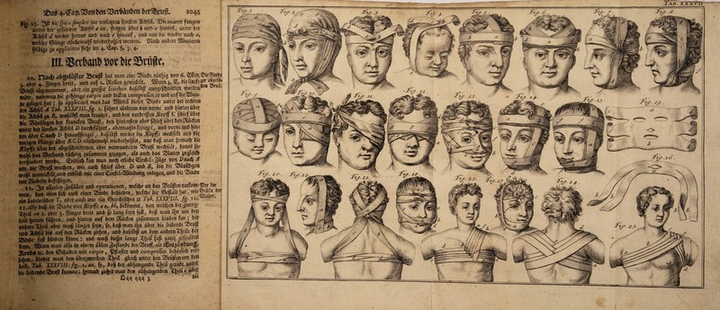 Fu 25. ^ft bie fpica fimptex jur verfemten finden Tfcbfcf* $>it tourcit fangen ■ unter ber gefunben Wfef a an t (teigen über* \mt.c bnmi1),, unter bet 2(c^fd d lieber ^ervor unb nach e hinauf , unb von öa meber nad> ay «Kfd)e ©änge ctÜcfcemahf tvicberhoy et werben* £ftod> anbere Sftwicten felbige au applicircn fie^c im 4. (£ap* §♦ 1* 4v iiLgSetbonbvotbic^öjlc» j 10 rrud> abtXcXoftt? 23i*uff (wf man eine SSinbe netbtg von 6. (Sffcn^ie&inbe ,, oöer 4. ginget breit, unb auf 2. »offen genudelt. SBemt j. £. OielincfeS« «M»' $3ruft abgenommen, ober ein gtojfcr fdrrhus bafctbft ausgefepnitten worben wäre/ unbma» bie gehörige carpie unb biefen comprelTcninunbaufbie^öum be gefeget fjat; fo appliciret man bas SSJKttcf tiefer SSinbe unter ber redeten m ^tpfel a Tab* XX.XTUI.fig. i. fahret aisbetm von vorne unb (unten über bie 7Cd>f«l ju By wofelbft man freutet, unb beit vorberßett -ftopff C fdjicfübec bie 23äufcpgcn bet fransen 25ruß, ben Jinterjien aberfepief über ben DSücfcn unter ber finden 2(cpfef D burcpfüfjref, abermals freunet7 unb vorne unb ptm ttn über Cnacp D hinaufßciget, bafcibjl tvteber btc itopffc weebfeft unb btc vorigen ©ängc über BCD etiiepemapf mcberfcojtfet, nur baß man pernaep bie «ftbpffe über ber abgefepnittenen ober venvunbeten 3Sruß tveepfeit, bamif fo* tvobl ba$ äerbanb tüchtig aufammen gezogen, afb auch bas bluten a«gicic^ verbinbert werbe* (SnbÜcp fan man noch etltdjc 0rdc£; güge von Bnach A um bie $9ru(J machen/ Mt auch fepief über D unb B> bis bie Q3äufcpgen n>o(rt unnvidefyunb enbitep mit einer £trdek2Smbung cnbtgen, unb bic 25tnbe mit Ökbetn befeßtgen* ^ 11* ^n aßerien gufätten unb Operationen; tvefepe an ben Grüßen vertonn 23er bie men, fan manftepauep einer 35inbc bebienen, ivclcpc bie ©eßait 6«?^ wtc^uae_bet ein lateimfepes T, ober auep wie ein ©ticcpjfdjcs n Tab. XXXTIiL fig. i o* 11* alfo baß btc 5$inbe vier .ßbpffc a av bh% bekommt, von wefepen bergwa' ‘Sbcil aa 2. ober 3» Segelt breit unb fo lang fcpn fofl, baß man ipn um ben icib perum führen, unb hinten auf bem Dvücfen aufammen btuben fan; ber anbere ^heit aber muß länger fcpn, fo, ba^man i^n über bie leibenbe ^rujf unb 3Ccbfei bis auf ben Dvücfcn aichen; unb bafeibp an bent anbem^^ciic bcc S5inbe feji btnben fbnne: unb muß biefer iange ^hc‘^ faP Öätft fepn* 2Bcnn man aifo in einem übfen gupanbe ber ^ruß/ais ^nt3unt>un0/ Rech* tc* ben 0d)aben mit carpie» ^pfiafler unb compreiTcn behorlid; ver^ (eben, binbet man ben überamerien öen Q3rüpcnum ben ieib, Tab. XXXTIII.fig. i, aay fo, ba£ ber abhongenbe £()cti gerabe untcr bie ieibenbe ^ruft fommc: fyxnaö) aiehet man ben abhangenben 3-heil c über Ügggqqs '^ K ^ ^— =—=— I