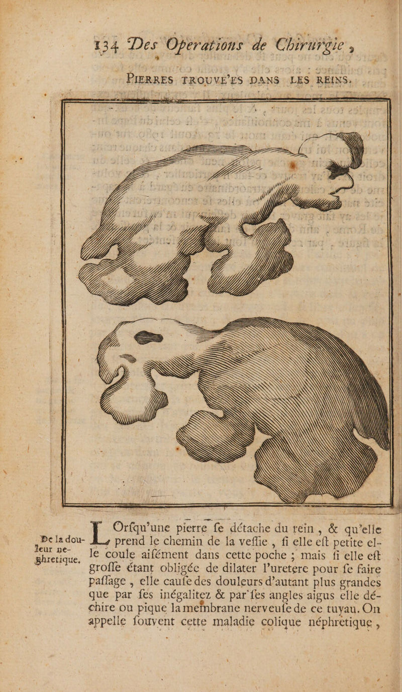 - PIERRES TROUVE’ES DANS LES REINS: 4 ape me Lan SCT GER de pierre fe détache du rein , &amp; qu’elle Bcladou- À, prend le chemin de la veffie , fi elle eft petite el- ou le coule aifément dans cette poche ; mais fi elle eft HE grofle étant obligée de dilater l’uretere pour fe faire paffage , elle caufe des douleurs d’autant plus grandes que par fes inégalitez &amp; par {es angles aigus elle dé- chire ou pique la meïnbrane nerveufe de ce tuyau. On appelle fouvent cette maladie colique néphretique , {