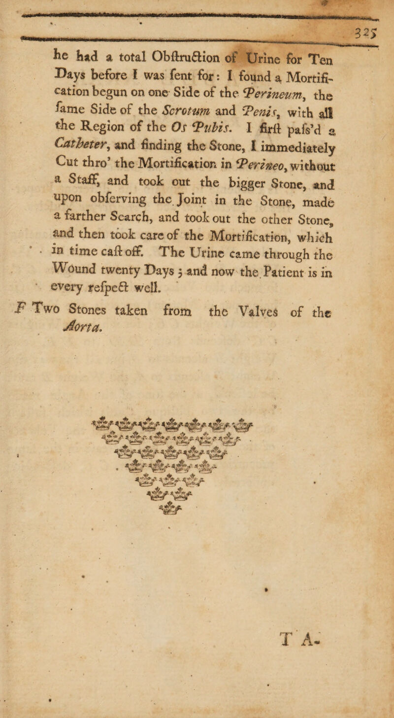 he had a total Obftruftion of Urine for Ten Bays before l was fent for: I found a Mortifi¬ cation begun on one Side of the ‘Perineum, the fame Side of the Scrotum and Penis, with ail the Region of the Os Pubis. I fir ft pafs’d a Catheter, and finding the Stone, I immediately Cut thro’ the Mortification in Perineo, without a Staff, and took out the bigger Stone, and upon obferving the Joint in the Stone, made a farther Search, and took out the other Stone* and then took care of the Mortification, which • in time cafl off. The Urine came through the Wound twenty Bays 5 and now the Patient is in every refpedl well. f Two Stones taken from the Valves of the Aorta. « T A-