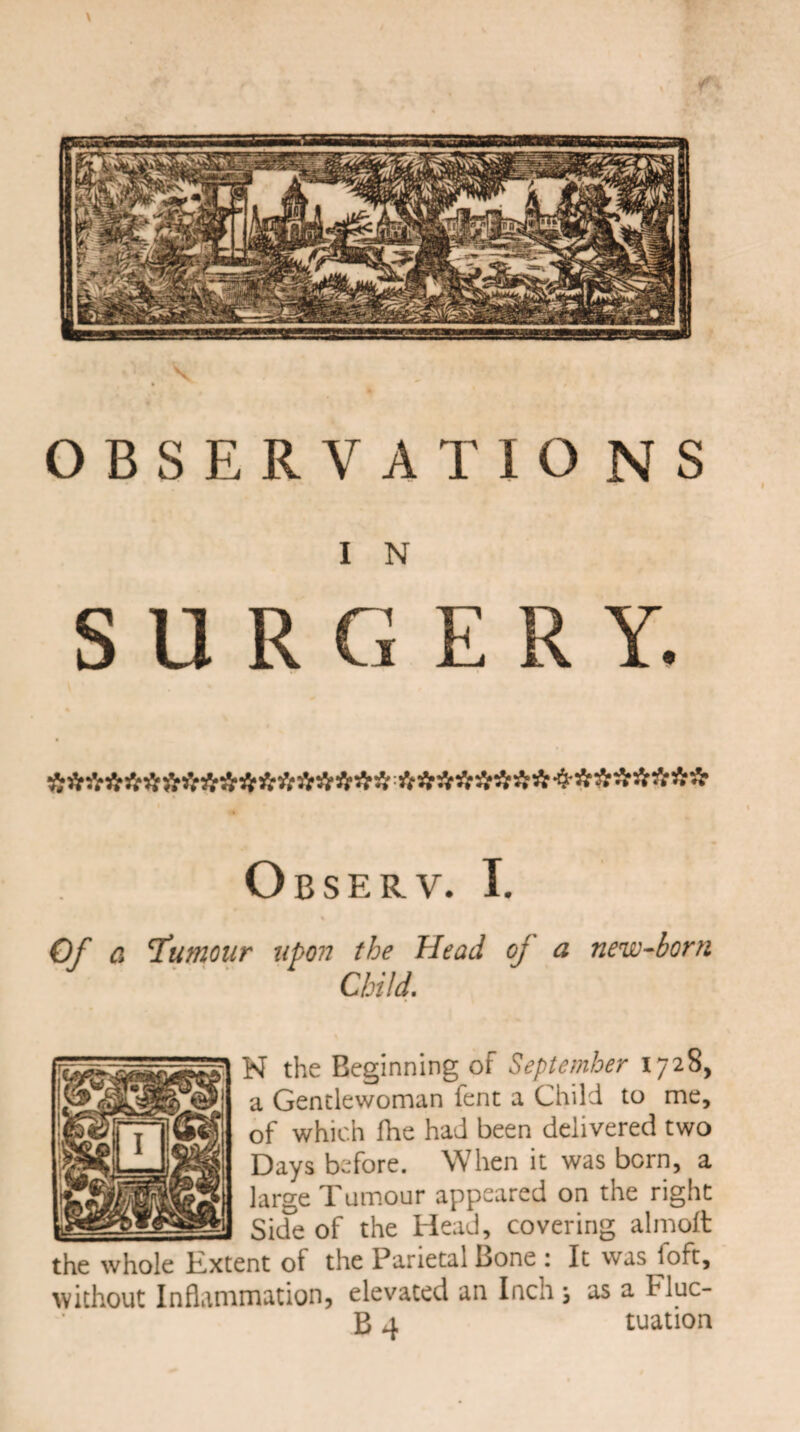 I N SURGERY. t ********************************** Observ. I. Of a 'Tumour upon the Head oj a new-born N the Beginning of September 1728, a Gentlewoman fent a Child to me, of which fhe had been delivered two Days before. When it was born, a large Tumour appeared on the right _ Side of the Head, covering almoft the whole Kxtent of the Parietal Bone : It was ^oft, without Inflammation, elevated an Inch ; as a Flue- B 4 tuation