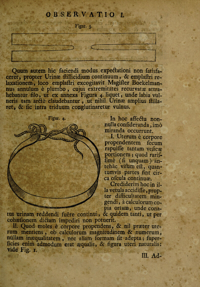 Figur. 3. Quum autem hic faciendi modus expedationi non fatisfa- ceret, propter Urinae ftillicidium continuum, & emplaftri re¬ laxationem, loco emplaftri excogitavit. Magifter Boekelman- nus annulum e plumbo, cujus extremitates recurvatae attra¬ hebantur filo, ut ex annexa Figura 4. liquet, unde labia vul¬ neris tam ard& claudebantur, ut nihil Urinae amplius ftilla- ret, & fic intra triduum conglutinaretur vulnus. Figur. 4. In hoc affedu non- x: nulla confideranda, imo miranda occurrunt. . I, Uterum e corpore propendentem fecum rapuifle tantam veficae portionem; quod rarif- fime (fi unquam) an¬ tehac vifumeft, quan¬ tumvis partes fint cir¬ ca ofcula continuit. Crediderim hoc in il¬ la vetula accidifte, prop¬ ter difficultatem min¬ gendi, a calculorum co¬ pia ortam, unde cona¬ tus urinam reddendi fuere continui, & quidem tanti, ut per cohaefionem didam impediri non potuerit. II. Quod moles 6 corpore propendens, & nil praeter ute¬ rum mentiens, ob calculorum magnitudinem & numerum, nullam inaequalitatem, nec aliam formam fit adepta; fuper- ficies enim admodum erat aequalis, & figura uteri naturalis: vide' Fig. 1.