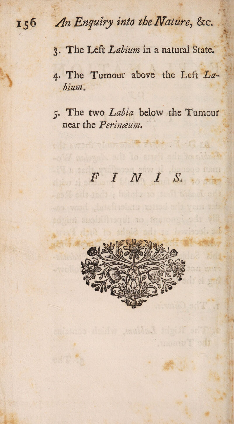 3. The Left Labium in a natural State. 4. The Tumour above the Left La- bium* *• 5. The two Labia below the Tumour near the Ferinceum. F I N 1 8&lt;