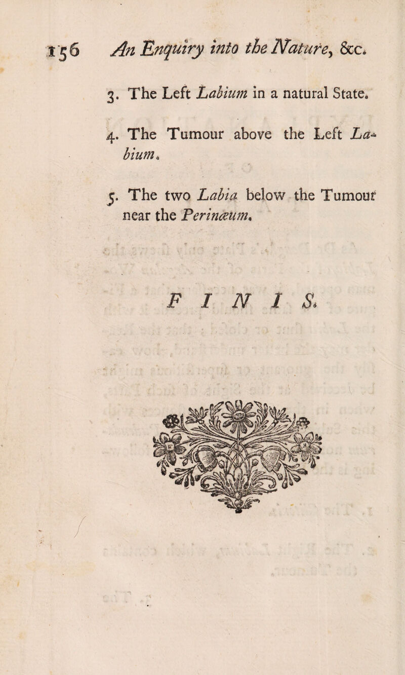 3. The Left Labium in a natural State, 4. The Tumour above the Left La* bium. 5. The two Labia below the Tumour near the Perinmm. F 1 N I S&gt;