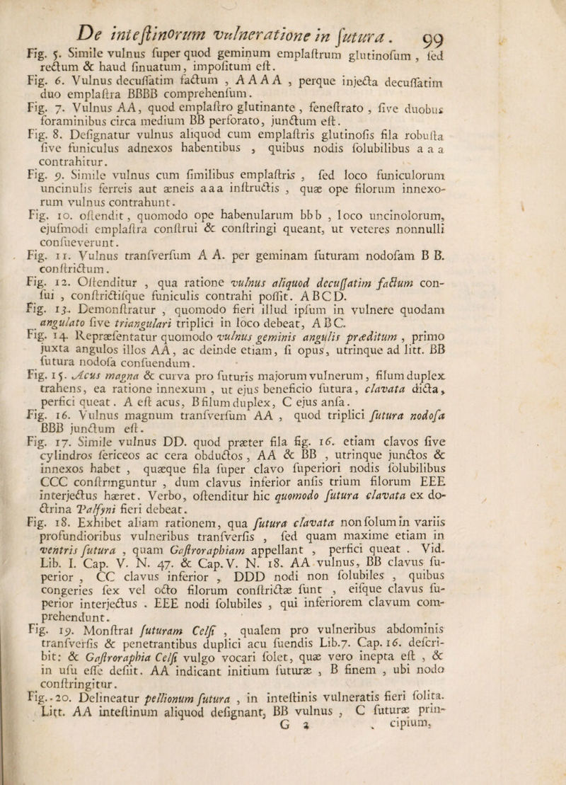 Fig. 5. Simile vulnus fuper quod geminum empladrum glutinofum , ied reCtum &amp; haud finuatum, impolitum eft. Fig. 6. Vulnus decudatim faCtum , AAAA , perque inje&amp;a decudatim duo emplaftra BBBB comprehenfum. Fig. 7. Vulnus AA, quod emplaftro glutinante, fenedrato , Uve duobus foraminibus circa medium BB perforato, junCtum eft. Fig. 8. Defignatur vulnus aliquod cum emplaftris glutinolis fila robufta live funiculus adnexos habentibus , quibus nodis folubilibus a a a contrahitur. Fig. * Simile vulnus cum fimilibus emplaftris , fed loco funiculorum uncinulis ferreis aut aeneis aaa inftruCtis , quae ope filorum innexo¬ rum vulnus contrahunt. Fig. 10. offendit, quomodo ope habenularum bbb , loco uncinolorum, ejufmodi emplaftra conftrui &amp; conltringi queant, ut veteres nonnulli confuev erunt. Fig. 11. Vulnus tranfverfum A A. per geminam futuram nodofam B B. conftriCtum. Fig. 12. Offenditur , qua ratione 'vulnus aliquod dccujjatim faftum con- fui , conftri&amp;ifque funiculis contrahi polfit. ABCD. Fig. 13.. Bemonftratur , quomodo fieri illud ipfum in vulnere quodam angulato live triangulari triplici in loco debeat, ABC. Fig. 14. Repraefentatur quomodo vulnUj geminis angulis proditum , primo juxta angulos illos AA, ac deinde etiam, li opus, utrinque ad litt. BB futura nodofa confuendum. Fig. 15. .Acus magna &amp; curva pro futuris majorum vulnerum, filum duplex trahens, ea ratione innexum , ut ejus beneficio futura, clavata diCta » perfici queat. A eft acus, B filum duplex, C ejus anfa. Fig. 16. Vulnus magnum tranfverfum AA , quod triplici futura nodofa BBB junCtum eft. Fig. 17. Simile vulnus DD. quod praeter fila fig. 16. etiam clavos live cylindros feticeos ac cera obduCtos , AA &amp; BB , utrinque junCtos &amp; innexos habet , quaeque fila fuper clavo fuperiori nodis folubilibus CCC condrmguntur , dum clavus inferior anlis trium filorum EEE interjectus haeret. Verbo, odenditur hic quomodo futura clavata ex do- Ctrina Valfyni fieri debeat. Fig. 18. Exhibet aliam rationem, qua futura clavata nonfolumin variis profundioribus vulneribus tranfverfis , fed quam maxime etiam in ventris futura , quam Gafirorapbiam appellant , perfici queat . Vid. Lib. I. Cap. V. N. 47. &amp; Cap.V. N. 18. A A vulnus, BB clavus fu- perior , CC clavus inferior , DDD nodi non folubiles , quibus congeries fex vel octo filorum conftriCtae funt , eifque clavus El¬ penor interjeCtus . EEE nodi folubiles , qui inferiorem clavum com¬ prehendunt. Fig. 15?. Monftraf futuram Celfi , qualem pro vulneribus abdominis tranfverfis &amp; penetrantibus duplici acu fuendis Lib.7. Cap. 16. defcri- bit; &amp; Gaftrorapbia Celfi vulgo vocari folet, quae vero inepta eft , &amp; in ufu effe dedit. AA indicant initium futurae , B finem , ubi nodo conltringi tur. Fig..20. Delineatur pellionum futura , in inteftinis vulneratis fieri foHta. Litt. A A intedinum aliquod defignant5 BB vulnus , C futurae priu- G % . cipium.