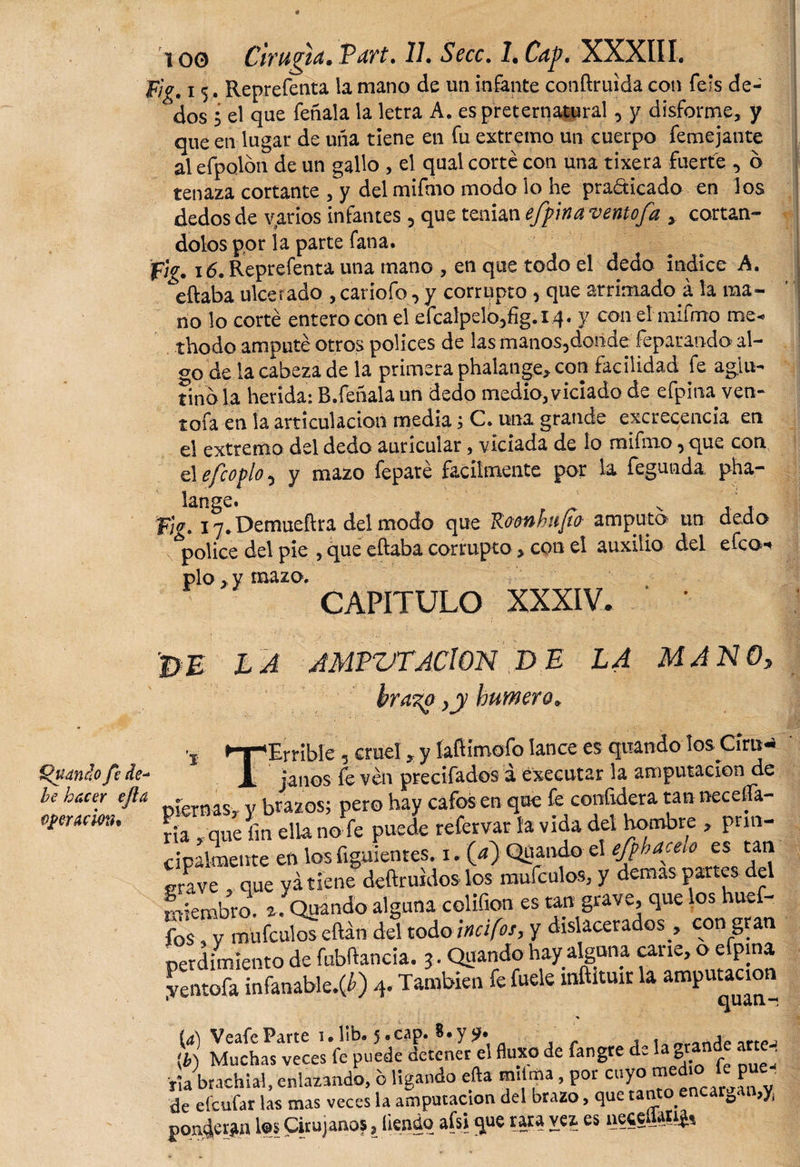 loo Cirugid.TdVt. 11. Secc. l.Cap. XXXIIL fla x 5. Repreíenta la mano de un infante conftruida con feis de¬ dos i el que feñala la letra A. es preternatural, y disforme, y que en lugar de uña tiene en fu extremo un cuerpo femejante al efpoión de un gallo , el qual corté con una tixera fuerte 6 tenaza cortante , y del mifmo modo lo he pra&amp;icado en los dedos de varios infantes 5 que tenían e/pina ventofa , cortán¬ dolos por la parte fana. f¡g. 16. Reprefenta una mano , en que todo el dedo indice A. eftaba ulcerado ,canqfoyy corrupto , que arrimado á la ma¬ no lo corté entero con el efcalpdo^fig.iq. y con el mifnrto me* thodo amputé otros pólices de las manos5donae feparando al¬ oo de la cabeza de la primera phalange, con facilidad fe aglu¬ tinóla herida: B.feñala un dedo medio, viciado de efpina ven¬ tola en la articulación media; C. una grande excrecencia en el extremo del dedo auricular, viciada de lo mifmo, que con el efe o pió ^ y mazo feparé fácilmente por la fegunda pha¬ lange* T¡g* iy.Demueftra del modo que Roonfntfo amputó un dedo pólice del pie , que eftaba corrupto&gt;con el auxilio del efeo- pío, y mazo. CAPITULO XXXIV. ' ' j&gt;J£ LA JMPVTACION DE LA MANO, brazo humero. {pando fi de- -&gt;e hacer ejla per ación. i- ‘Errible, cruel, y laftimofo lance es quando los Círu- a. janos fe ven precifados á executar la amputación de piernas,, y brazos; pero hay cafes en que fe eonfidera tan necelía- ria « que fin ella no fe puede refervar ía vida del hombre , prin¬ cipalmente en los figuientes. i. (a) Quando el efphactuó es tan grave «que y atiene deftruidos los mufculos, y demas partes del miembro, a .'Quando alguna colifion es tan grave, que los huef- fos, y mufculos eftán del todo incifos, y dilacerados , con gran mordimiento de fubftancia. j. Quando hay alguna carie, o efp na yentoík fefanable.(¿) 4. Tanfekn fe fode inftituit la amputación * (4) Veafe Parte 1. lib. 5. cap. 8. y y. . níie &lt;¿) Muchas veces fe puede detener el fluxo de fangte de la grande arte . ría brachial, enlazando, b ligando efta m.lma, por cuyo «ledio le pue de efeufar las mas veces la amputación del brazo, que tanto.encar0at ,y, ponderan l®s Cirujanos, liendo afsi que rara vez es necellarij,