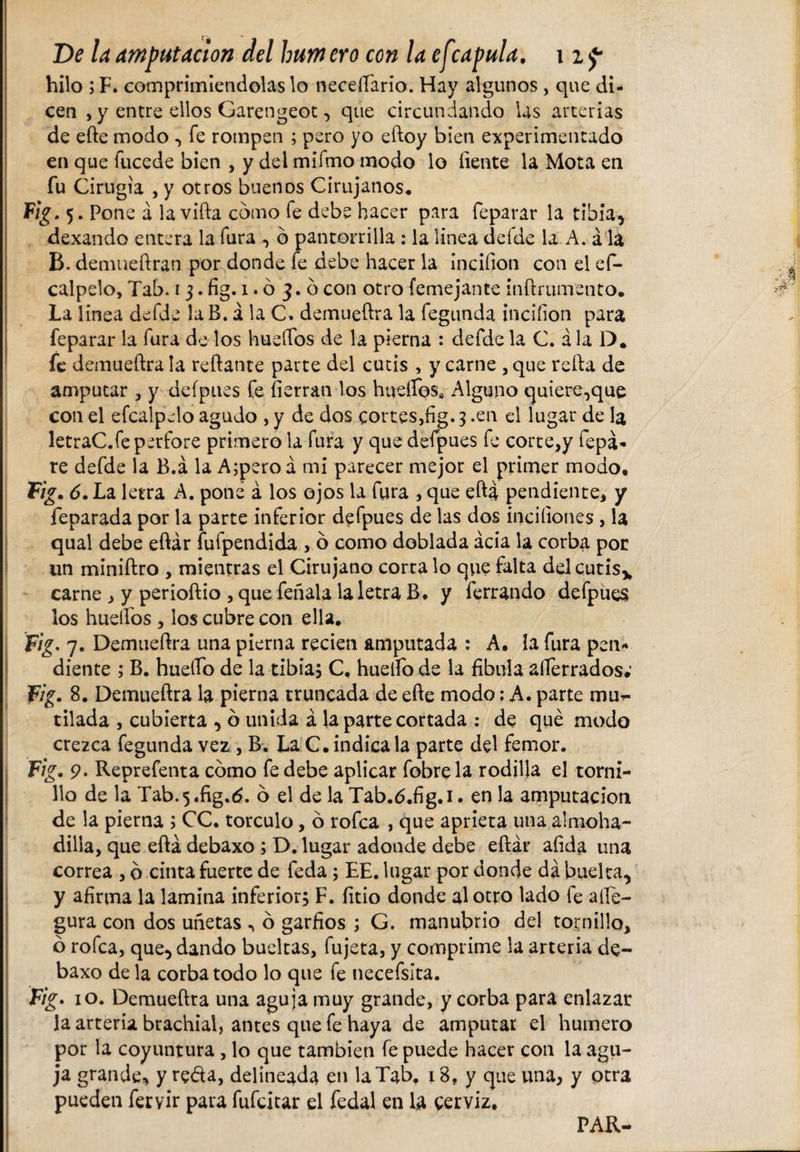 hilo ; F. comprimiéndolas lo neceííario. Hay algunos , que di¬ cen , y entre ellos Garengeot, que circundando las arterias de efte modo , fe rompen ; pero yo eftoy bien experimentado en que fucede bien , y del mifmo modo lo líente la Mota en fu Cirugía , y otros buenos Cirujanos* . Pone á la vida como fe debe hacer para feparar la tibia, dexando entera la fura , ó pantorrilla : la linea defde la A. á la B. demueftran por donde fe debe hacer la ¡ncifion con el ef- calpelo, Tab. 13. fig. 1.03.6 con otro femejante inílrumento. La linea defde la B. á la C. demueftra la fegunda ¡nciíion para feparar la fura de los huellos de la pierna : defde la C. á la D# fe demueftra la reliante parte del cutis , y carne , que reda de amputar , y deípues fe (ierran los hueíTos» Alguno quiere,que con el efcalpelo agudo , y de dos cortes,fíg. 3 .en el lugar de la letraC.fe perfore primero la fura y que defpues fe corte,y fepá* re defde la B.á la A;peroá mi parecer mejor el primer modo. Fig. 6. La letra A. pone á los ojos la fura , que eftá pendiente, y feparada por la parte inferior defpues de las dos inciíiones , la qual debe eftár fufpendida , ó como doblada acia la corba por un miniftro , mientras el Cirujano córtalo que falta del cutis* carne , y perioftio , que feñala la letra B. y ferrando defpues los huellos , los cubre con ella. Fig. 7. Demueftra una pierna recien amputada : A. la fura pen* diente ; B. huello de la tibia; C, huelfo de la fibula alferrados; Fig. 8. Demueftra la pierna truncada de efte modo; A. parte mu~ tilada , cubierta , ó unida á la parte cortada : de qué modo crezca fegunda vez , B. La C. indícala parte del femor. Fig. 9. Reprefenta cómo fe debe aplicar fobrela rodilla el torni¬ llo de la Tab. 5 .fig.6. ó el de la Tab.ó.fig. 1. en la amputación de la pierna ; CC. torculo, ó rofca , que aprieta una almoha¬ dilla, que eftá debaxo ; D. lugar adonde debe eftár afida una correa , ó cinta fuerte de feda; EE. lugar por donde da buelta, y afirma la lamina inferior; F. fitio donde al otro lado fe alie- gura con dos uñetas , ó garfios ; G. manubrio del tornillo, ó rofca, que, dando bueltas, fujeta, y comprime la arteria de¬ baxo de la corba todo lo que fe necefsita. Fig. 10. Demueftra una aguja muy grande, y corba para enlazar la arteria brachial, antes que fe haya de amputar el humero por la coyuntura , lo que también fe puede hacer con la agu¬ ja grande, y reda, delineada en la Tab. 18, y que una, y otra pueden fervir para fufcitar el fedal en la cerviz. PAR-