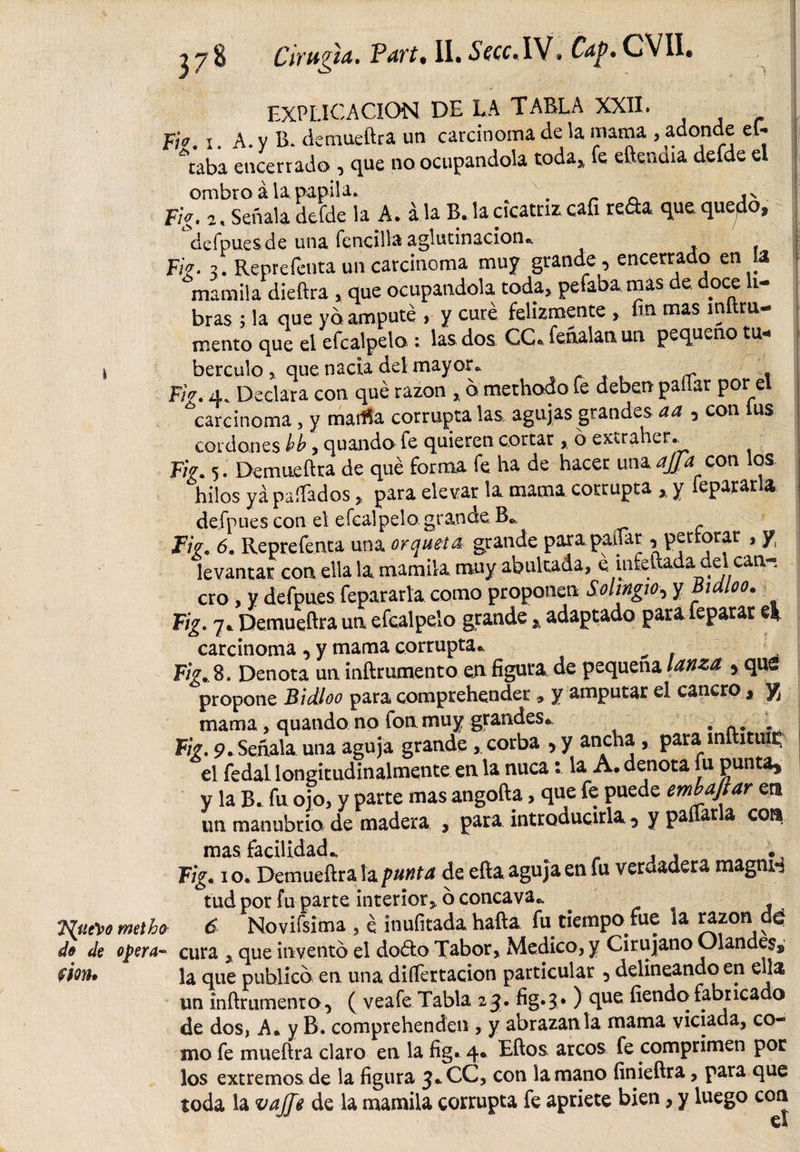 Jileco metho ® de opera- ^ 7 8 Cirugía. Vart. II. *S»w.lV. Cap. CVII. EXPLICACION DE LA TABLA XXII. F/V. i. A. y B* demueftra un carcinoma de la mama , adonde el-. %aba encerrado , que no ocupándola toda,, le eftendia delde el ombro á la papila. _ n ,s Fig. 2. Señala defde la A. a la B. la cicatriz cafi reda que. quedo, defpues de una fencilla aglutinación* F/V. 2. Reprefenta un carcinoma muy grande , encerrado en la mamila dieftra , que ocupándola toda, pefabamas de doce li¬ bras ; la que vd amputé &gt; y cure felizmente , En mas m ra¬ mento que el efcalpelo : las dos CC® fenalan un pequeño tu* berculo, que nacía del mayor. r , F/V. 4. Declara con qué razón * d methodo fe deben pallar por el ^carcinoma , y maílla corrupta las agujas grandes aa , con lus cordones bb, quando fe quieren cortar , o extraher.^ Fig. 5. Demueftra de qué forma fe ha de hacer una ajja con os hilos ya paliados, para elevar la mama corrupta * y fepararla defpues con el efcalpelo.grande Ba .F/V. 6. Reprefenta una arqueta grande para patiar, perforar , y levantar con ella la. mamila muy abultada, é infeftada del can¬ cro , y defpues fepararla como proponen Sohwo, y Builoo. Fig. 7* Demueftra un efcalpelo grande, adaptado parafeparar el F/V. 8. Denota un inftrumento en figura de pequeña lanza , que propone Bidloo para comprehendet, y amputar el cancro, yÁ mama, quando no fon muy grandes., . *. . F/V. 9. Señala una aguja grande, corba , y ancha , para mftituit; el fedal longitudinalmente en la nuca: la A. denota fu puntas y la B. fu ojo, y parte mas angofta, que fe puede embajar en un manubrio de madera * para introducirla , y paliarla con mas facilidad., Fig. 1 o. Demueftra la punta de efta aguja en fu verdadera magnH tud por fu parte. interior,, ó cóncava.. . s 6 Novifsima , é inuíitada hafta fu tiempo fue ía razón dq cura , que inventó el dodto Tabor, Medico, y Cirujano Glandes,, la que publicó en una diífertacion particular , delineando en ella un inftrumento, ( veafe Tabla 23. fig.3* ) clue fiendofabricado de dos, A. y B. comprehenden , y abrazan la mama viciada, co¬ mo fe mueftra claro en la fig. 4° Eftos arcos fe comprimen por los extremos de la figura 3*CC, con la mano finieftra, para que toda la vajge de la mamila corrupta fe apriete bien, y luego con un