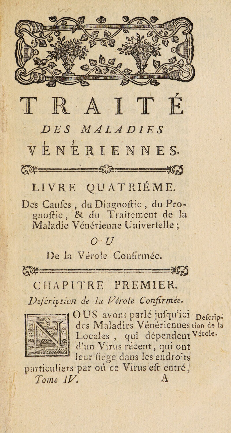 DES MALADIES VENERIENNES. —==^ LIVRE QUATRIÈME. Des Caufes , du Dia^noftic , du Pro- ^noUic, & du Traitement de la Maladie Vénérienne Uiiiverfelle ; O-U De îa Vérole Confirmée. CHAPITRE PREMIER. Dsfcrlptîon de la Vérole Confirmée» O US avons parlé iufqu’ici Defcrîp- des Maladies Vénériennes tion de la Locales , qui dépendent d’un V irus récent, qui ont leur fiege dans les endroits particuliers par où ce Virus efî: entré j Tome IV. A