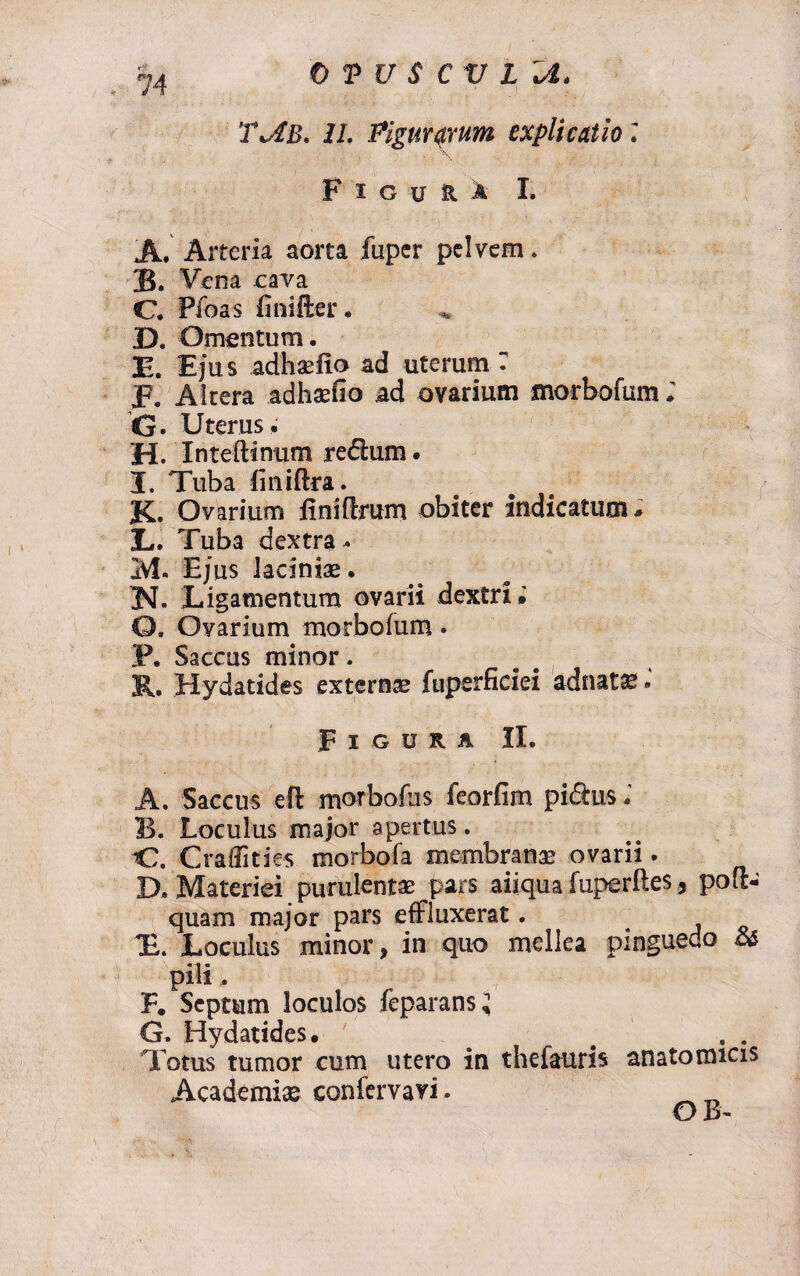 J4 0 T U S C V L %A* ’l\dB. 1L Piguurum explicatio; Figura I. A. Arteria aorta fuper pelvem. B. Vena eava C. Pfoas linifter. D. Omentum. E. Ejus adhaefio ad uterum r F. Altera adhasfio ad ovarium morbofum ; G. Uterus. H. Inteftinum redlum. I. Tuba liniftra. K. Ovarium iiniftrum obiter indicatum, X,. Tuba dextra- M. Ejus lacinias. JL Ligamentum ovarii dextri» O. Ovarium morbofum. P. Saccus minor. R. Hydatides externas ftiperficiei adnat^. Figura II. A. Saccus eft morbofus feorfim pi&us - 13. Loculus major apertus. C. C radit i es morbofa membranas ovarii. D. Materiei purulentae pars aiiqua fuperftes, pofl- quam major pars effluxerat. T. Loculus minor, in quo mellea pinguedo & pili. F. Septum loculos feparans l G. Hydatides» Totus tumor cum utero in thefauris anatomicis Academiae confervavi • _ _ OB'