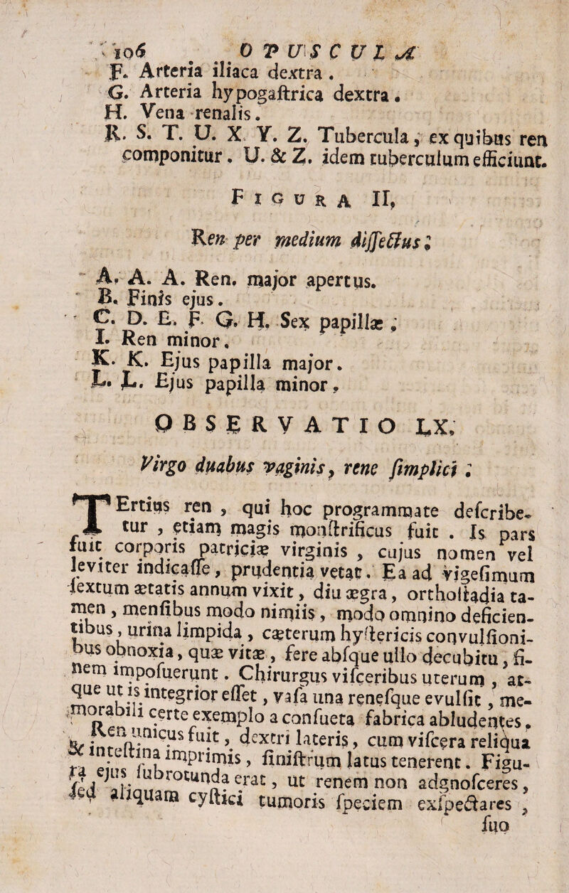 'Sto* . _0 TUSCULI F* Arteria iliaca dextra . G. Arteria hypogaltrica dextra, H. Vena renalis. R« S. T. U. X Y. Z. Tubercula 5 ex quibus ren componitur. U. & Z. idem tuberculum efficiunt. Figura II, V Ren per medium Affixus ® A. A. A. Ren. maior apertus. B. Finis ejus. C. D. E. F Q. H. Sex papilla;; I. Ren minor, K. K. Ejus papilla major. JL. E» Ejus papilla minor, P B S E R V A T I O LX. rv-i ■ ' -c- - . • • lJ : ; , J ■ l *. ; V > duabus vaginis, rene ftmplici; Ertiqs ren , qui hoc programmate defcribe- , tur , etiam magis monfirificus fuit . Is pars fuit corporis patrici* virginis, cujus nomen vel J e viter indicafle, prudentia vetat. Ea ad Vigefirnum iextutn itatis annum vixit, diu aegra, orthoitadia ta¬ men , menfibus modo nimiis, modo omnino deficien¬ tibus, urina limpida , ceterum hyftericis convulfioni- bus obnoxia, quae vitae, fere abfque ullo decubitu. fi. nem lmpofueriint. Chirurgus vifcenbus uterum , at- que ut is integrior effet, vafa ima renefque evulfic , me- ,nK>rabih certe exemplo a confueta fabrica abludentes. & inrr^wUS 5. c*exeri lacer^ 9 cum vifc^ra reliqua r* Jnl r1Klmpr,7?LS > finiftrum latus tenerent. Figu- fed ai-in» loCunda erat, ut renem non adgnofceres, qiam cyftici tumoris fpeciem exfpedares , fuo