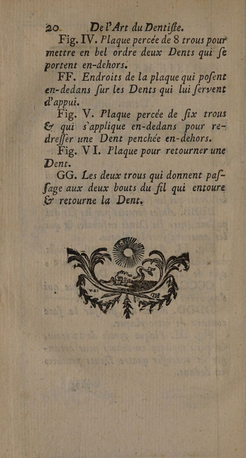 Fig. IV. Plaque percée de 8 trous pour mettre en bel ordre deux Dents qui fe portent en-dehors. FF. Endroits de la plaque qui pofent en-dedans fur les Dents qui lui fervent d'appui. Fig. V. Plaque percée de fix trous € qui s'applique en-dedans pour re- dreffer une Dent penchée en-dehors. Fig. VI. Plaque pour retourner une Dent. GG. Les deux trous qui donnent DLfE fage aux deux bouts du fil qui entoure &amp; retourne la Dent,