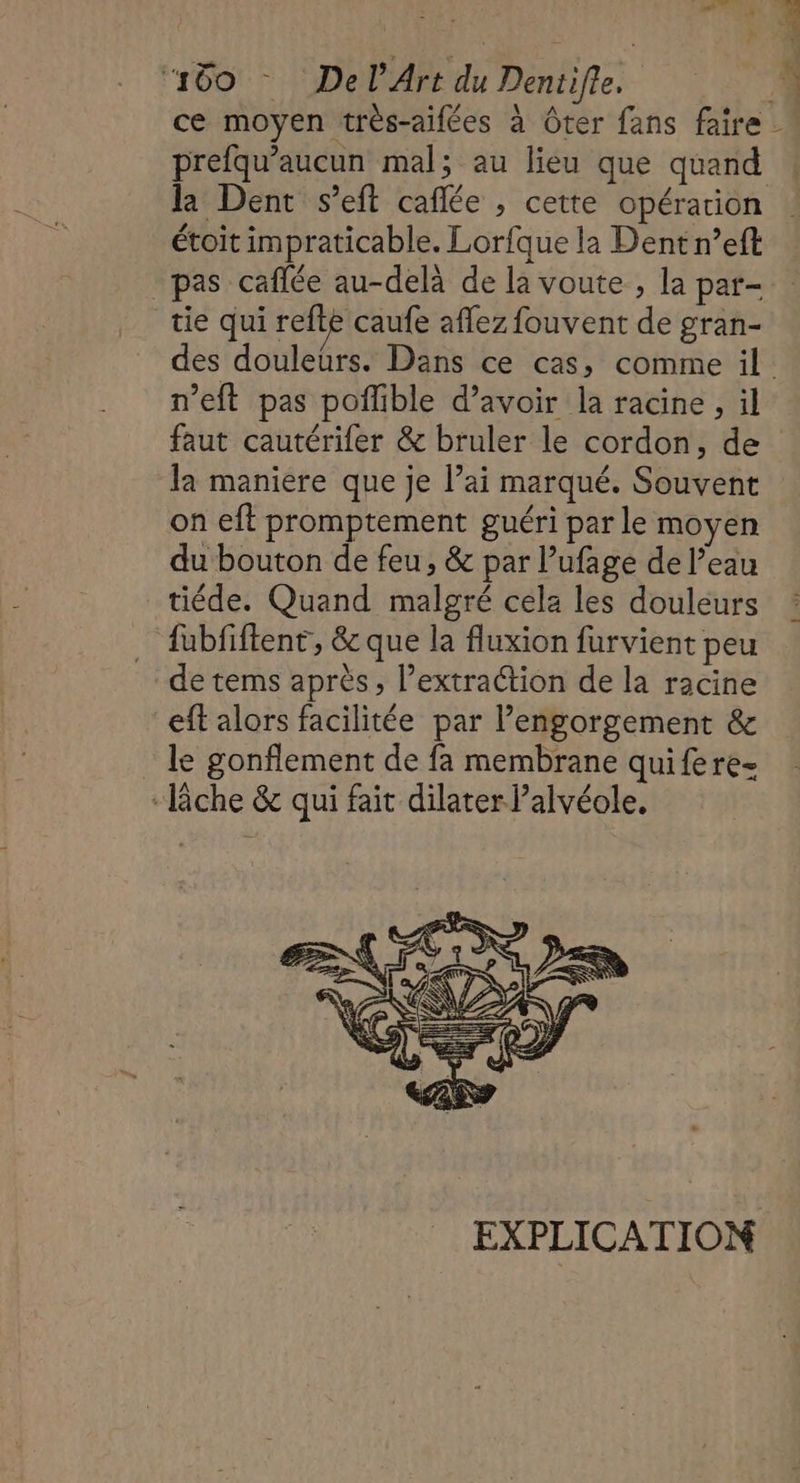 la Dent s’eft caflée ; cette opération étoit impraticable. Lorfque la Dent n’eft pas caflée au-delà de la voute , la par- tie qui refte caufe aflez fouvent de gran- n’eft pas poflible d’avoir la racine, il 4 la maniere que je l’ai marqué. Souvent on eft promptement guéri par le moyen du bouton de feu, &amp; par Pufage de l’eau tiéde. Quand malgré cela les douleurs fubfiftent, &amp; que la fluxion furvient peu de tems après, l'extraction de la racine eft alors facilitée par lengorgement &amp; le gonflement de fa membrane quifere- “lâche &amp; qui fait dilater l’alvéole. EXPLICATION