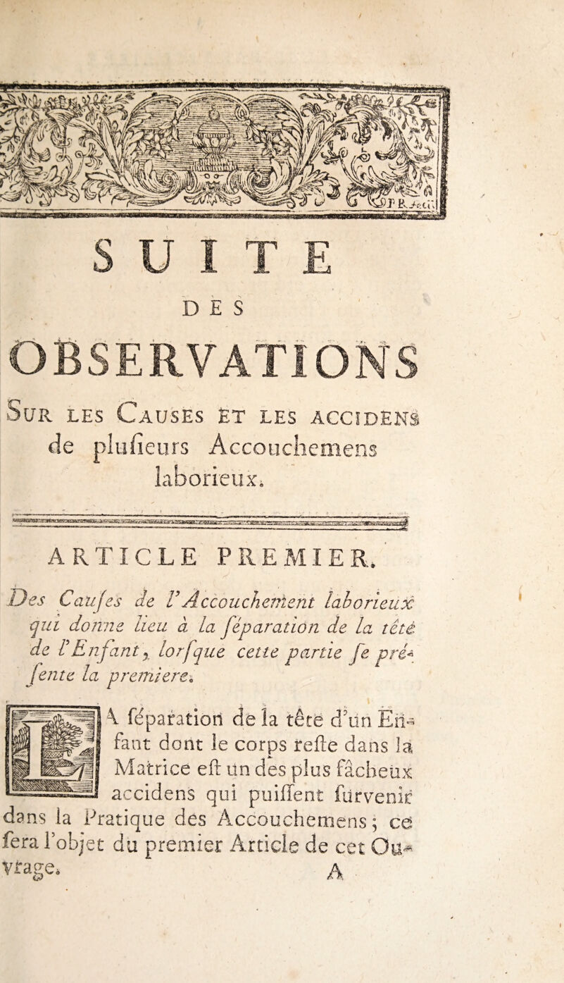 / SUITE * DES Sur les Causes et les accident de plu lien rs Accouchemens laborieux, ARTICLE PREMIER.' t - j Des Caujes de VÀccouchenlent laborieux qui donne heu à la féparation de la tété de h Enfant x lorfque cette partie fe pré* jente la première. \ féparation de la tête d’un En¬ fant dont le corps relie dans là Matrice eft un des plus fâcheux accidens qui puiffent fur venir dans la Pratique des Accouchemens ; ce fera l’objet du premier Article de cet 0ü* Virage, A