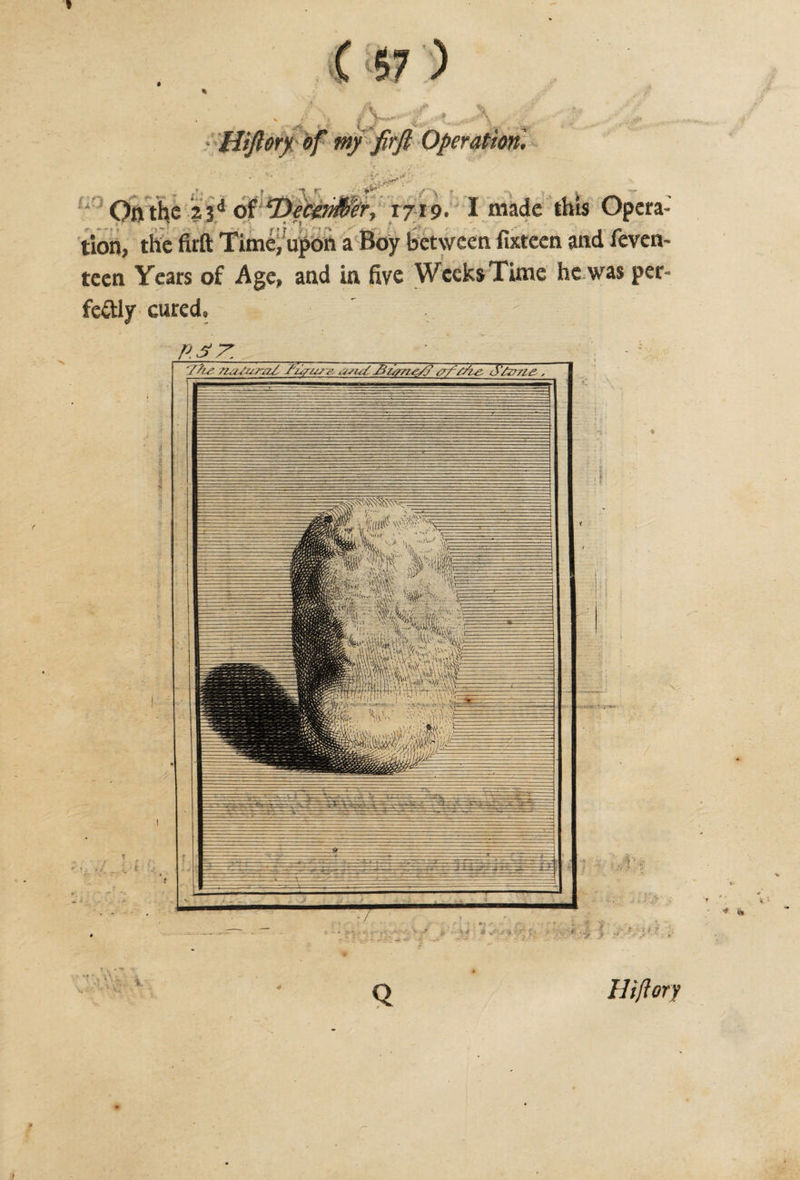 ’ - - Hiftory of my firfi Operation. &amp; On the 23d of ^Dec&amp;HHer, 1719. I made this Opera¬ tion, the firft Time, upon a Boy between fixteen and feven- teen Years of Age, and in five Weeks Time he was per¬ fectly cured. P.S/7. v 1