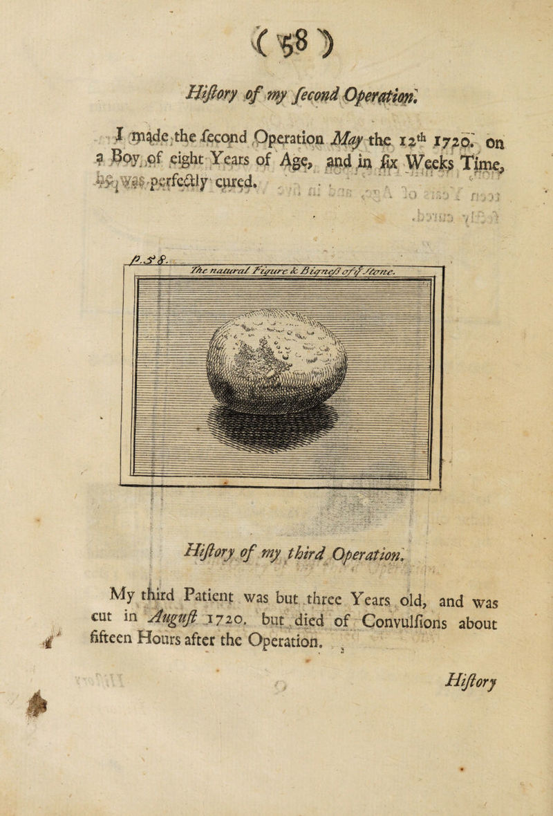 Hftory of my fecond Operation. I ni^de the fecqnd Operation May the jj* 1720.' on ? B°y of eight Years of Ape, and in fa Weeks Time omettiv cured. H (* Hiftory of my third Operation. My third Patient was but three Years old, and was cut in Auguft 1720. but died of Convulfions about fifteen Hours after the Operation.