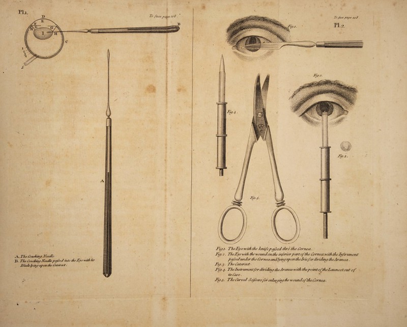 Pla. X) _A.. The Couching CVeedte I 1]. The touching Fcedtc pa fed into the Tv c with its J3lade lying upon the Taiaraot. To /ace page 108 • 9 Ficyj. TkeEye with the knife pafred thro the Cornea. Fug. 2. TheFye with the wound on the inferior parr of the Cornea,with the TnftrumenT pa/sed under the Cornea and lying upon the Iris for dividing theAranea . Figs. The Cataract Fig. 4. The Tnsti ament for dividing theAranea with the point of theTauneetout of its Cise. Fui-5- The Curved Seifrarsfor enlarging the w oundof the Cornea . l