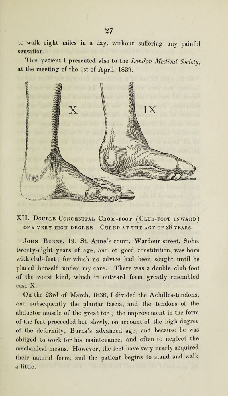 sensation. This patient I presented also to the London Medical Society, at the meeting of the 1st of April, 1839. XII. Double Congenital Cross-foot (Club-foot inward) OF A VERY HIGH DEGREE-CURED AT THE AGE OF 28 YEARS. John Burns, 19, St. Anne’s-court, Wardour-street, Soho, twenty-eight years of age, and of good constitution, was born with club-feet; for which no advice had been sought until he placed himself under my care. There was a double club-foot of the worst kind, which in outward form greatly resembled case X. On the 23rd of March, 1838, I divided the Achilles-tendons, and subsequently the plantar fascia, and the tendons of the abductor muscle of the great toe ; the improvement in the form of the feet proceeded but slowly, on account of the high degree of the deformity, Burns’s advanced age, and because he was obliged to work for his maintenance, and often to neglect the mechanical means. However, the feet have very nearly acquired their natural form, and the patient begins to stand and walk a little.