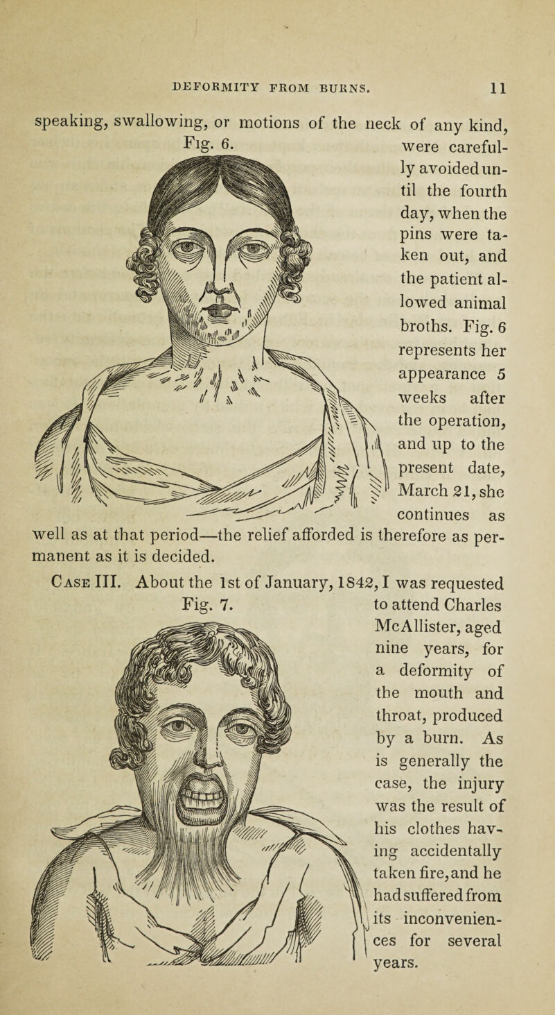 speaking, swallowing, or motions of the neck of any kind, Fig. 6. were careful¬ ly avoided un¬ til the fourth day, when the pins were ta¬ ken out, and the patient al¬ lowed animal broths. Fig. 6 represents her appearance 5 weeks after the operation, and up to the present date, March 21, she continues as well as at that period—the relief afforded is therefore as per¬ manent as it is decided. Case III. About the 1st of January, 1842,1 was requested Fig. 7. to attend Charles McAllister, aged nine years, for a deformity of the mouth and throat, produced by a burn. As is generally the case, the injury was the result of his clothes hav¬ ing accidentally taken fire,and he had suffered from its inconvenien¬ ces for several years.